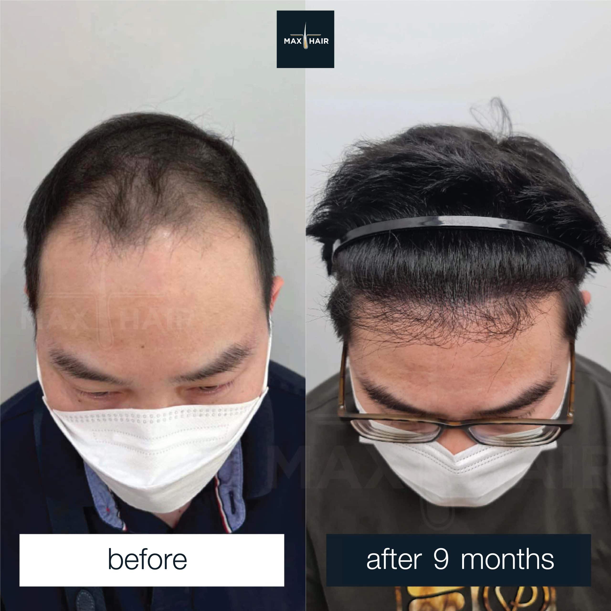 Male hair transplant results MCG 2,800 grafts after 9 months