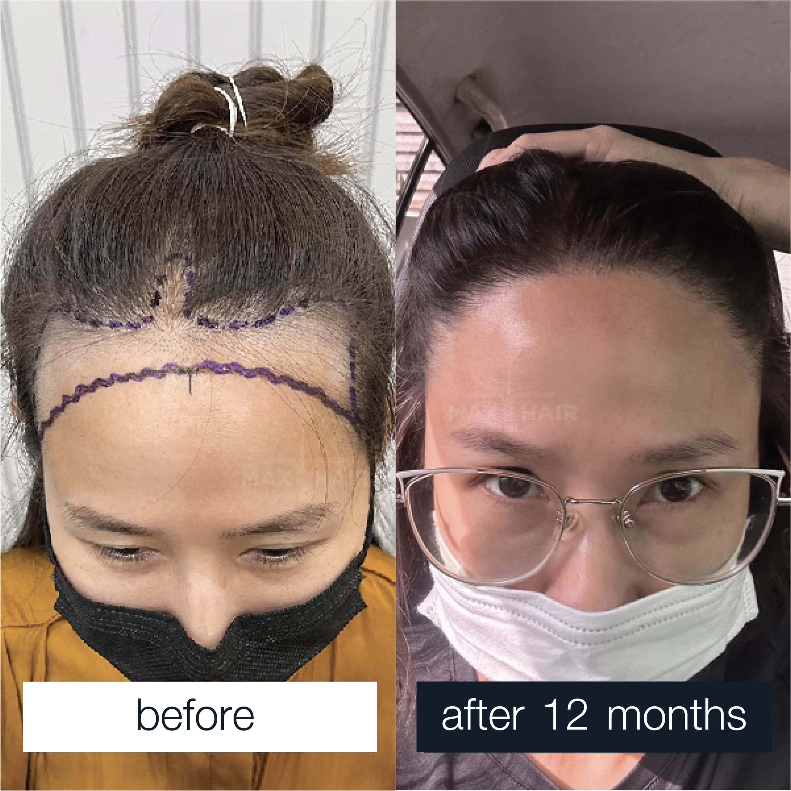 Woman's satisfied hair transplant before and after results months later