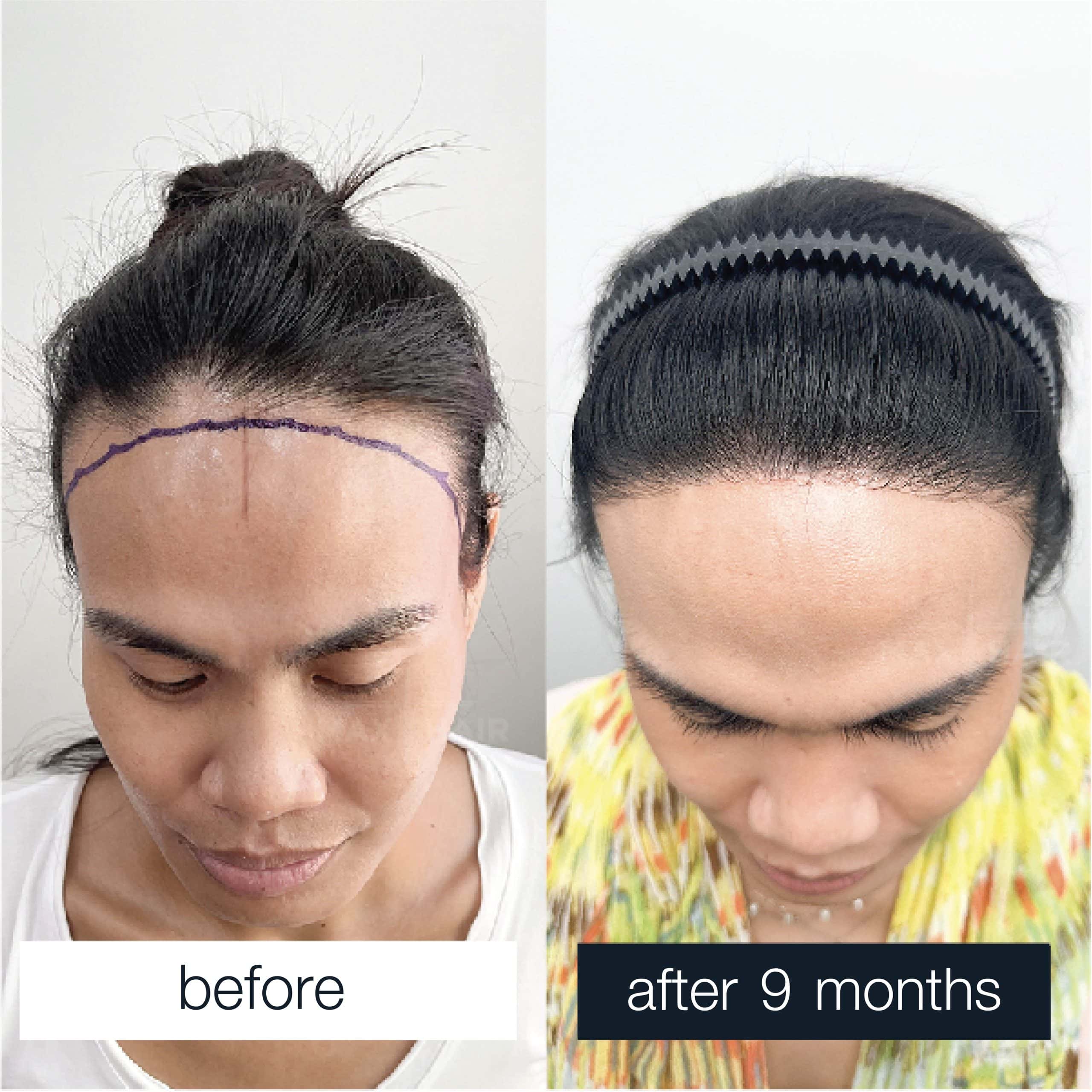 Before and after images of a patient demonstrating success