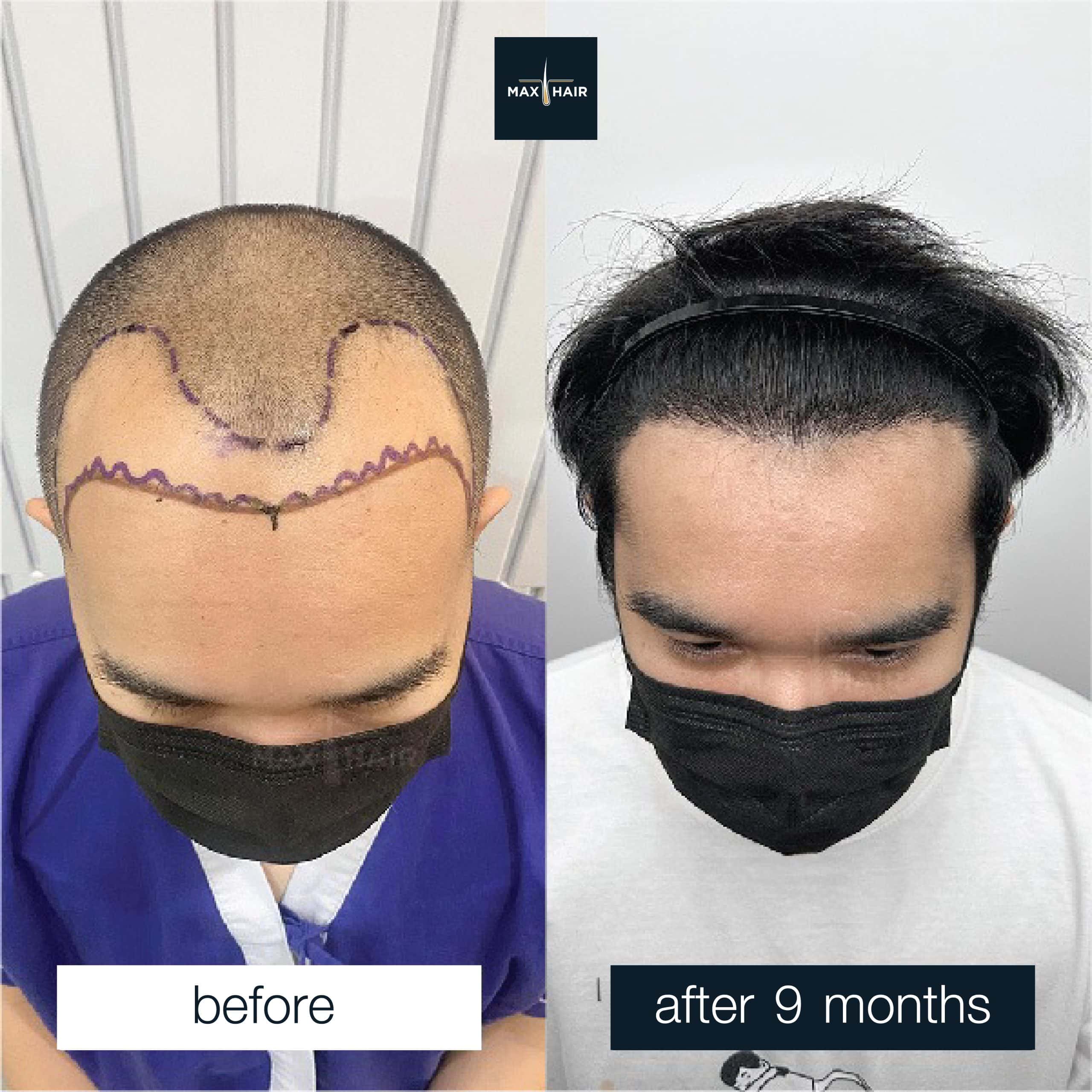 Male hair transplant case reviews and results at Max Hair Clinic