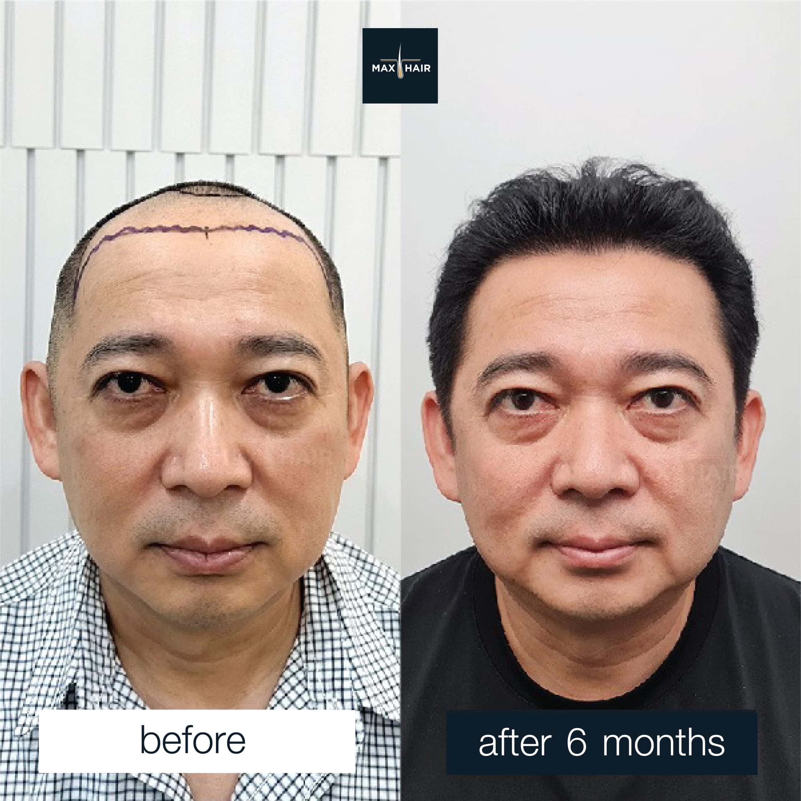Hair transplant MCG 3,400 grafts results after 6 months