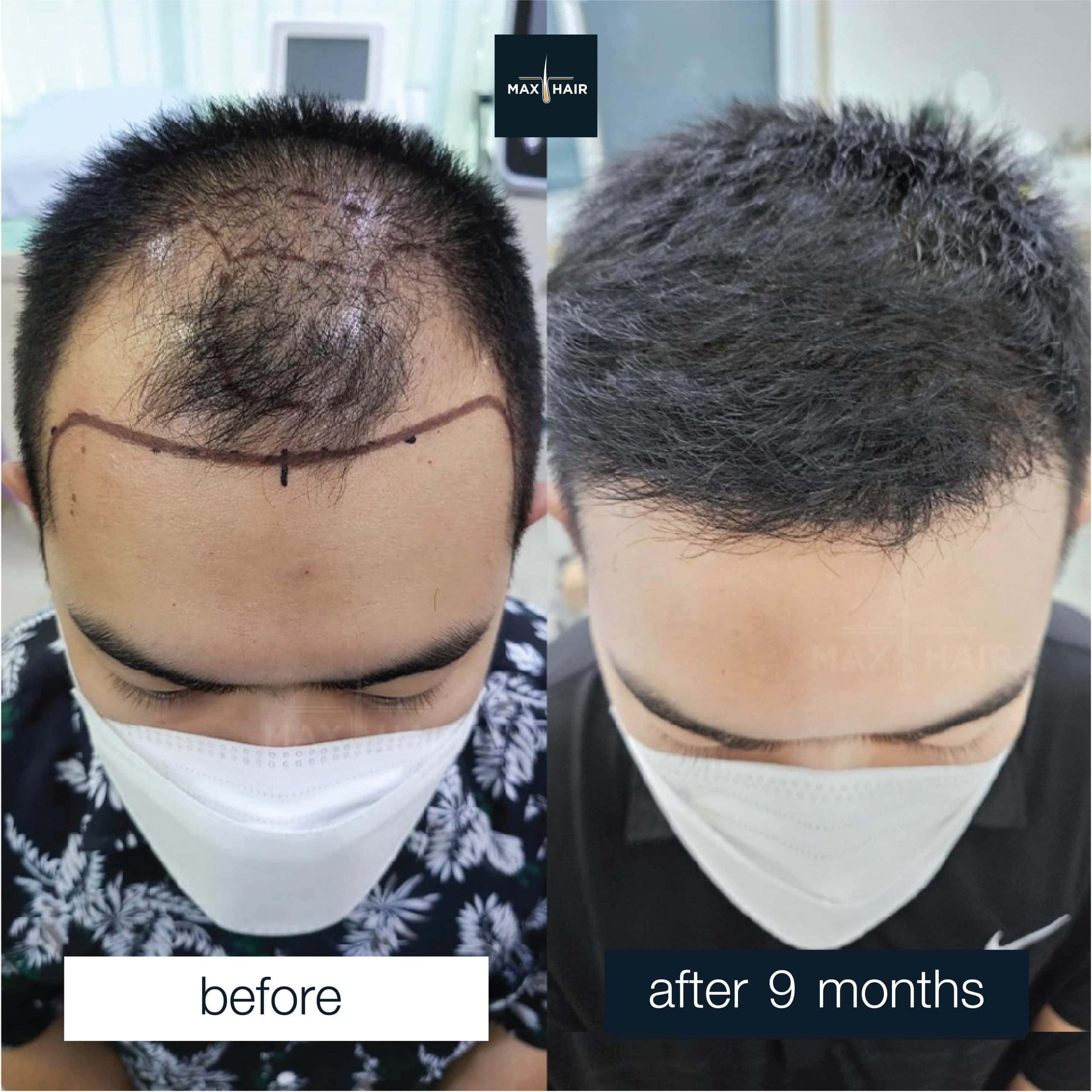 review MCG hair transplantation 3,000 grafts