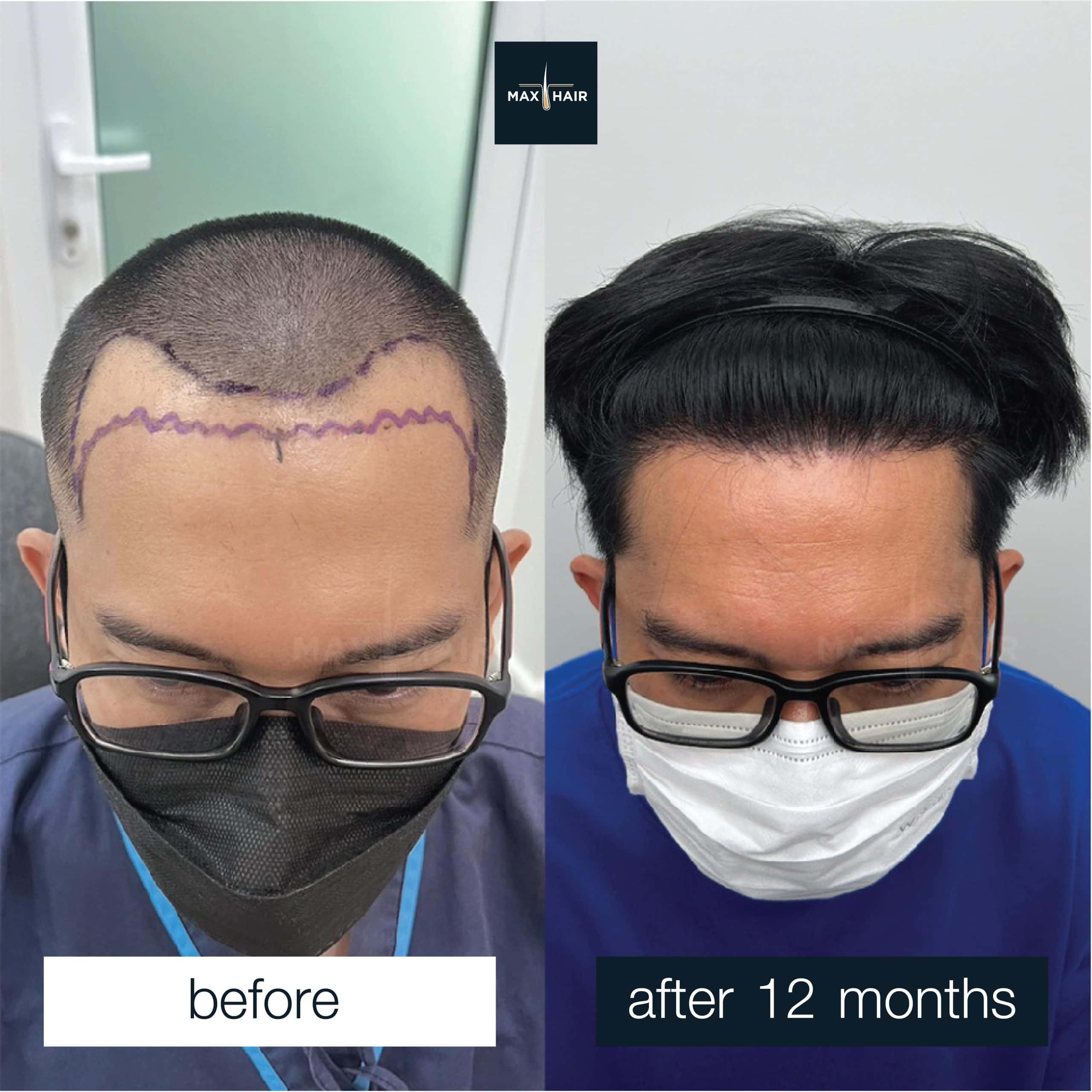 Hair transplant before and after 12 months in man with frontal hairline restoration