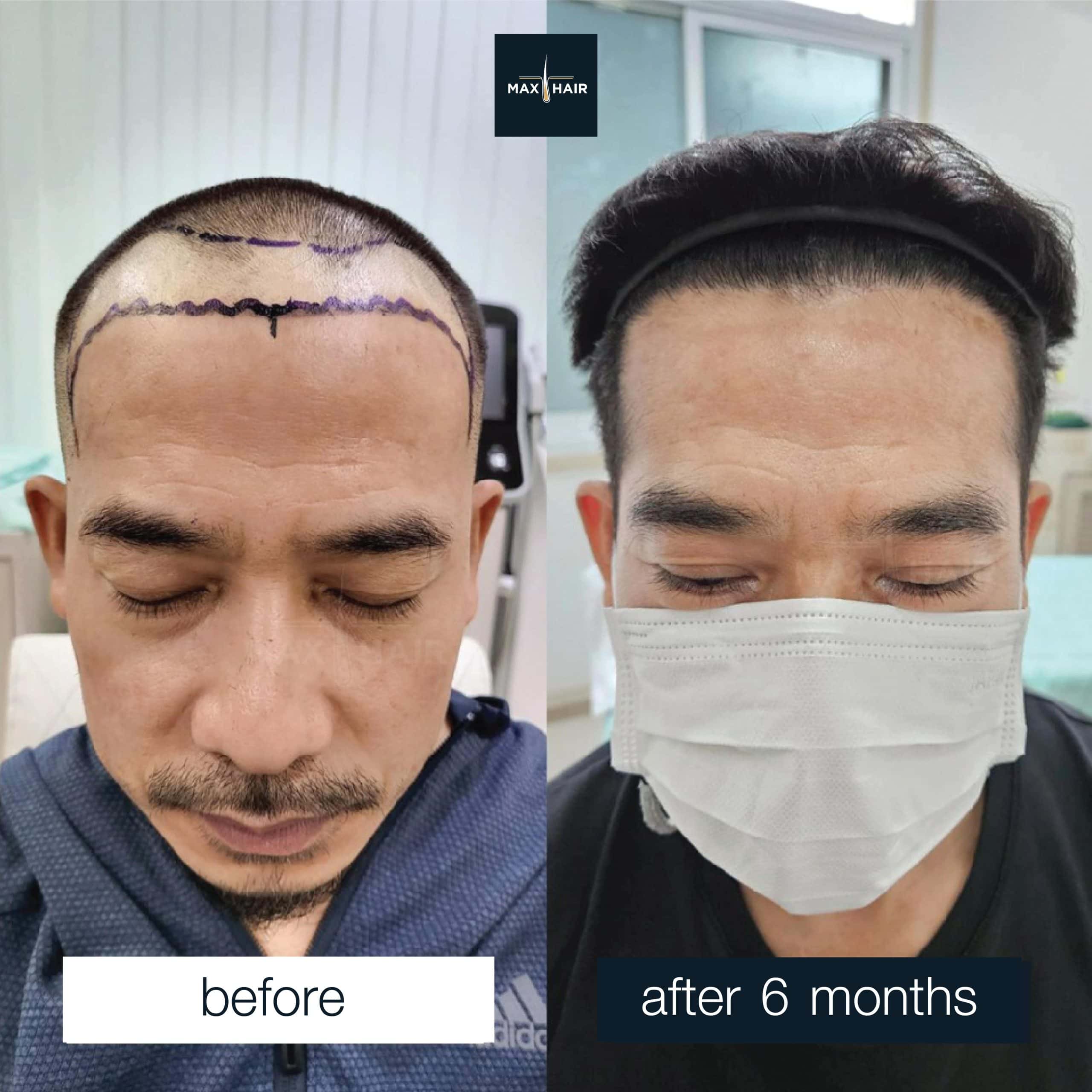Male hair transplant results MCG 2,550 grafts after 6 months