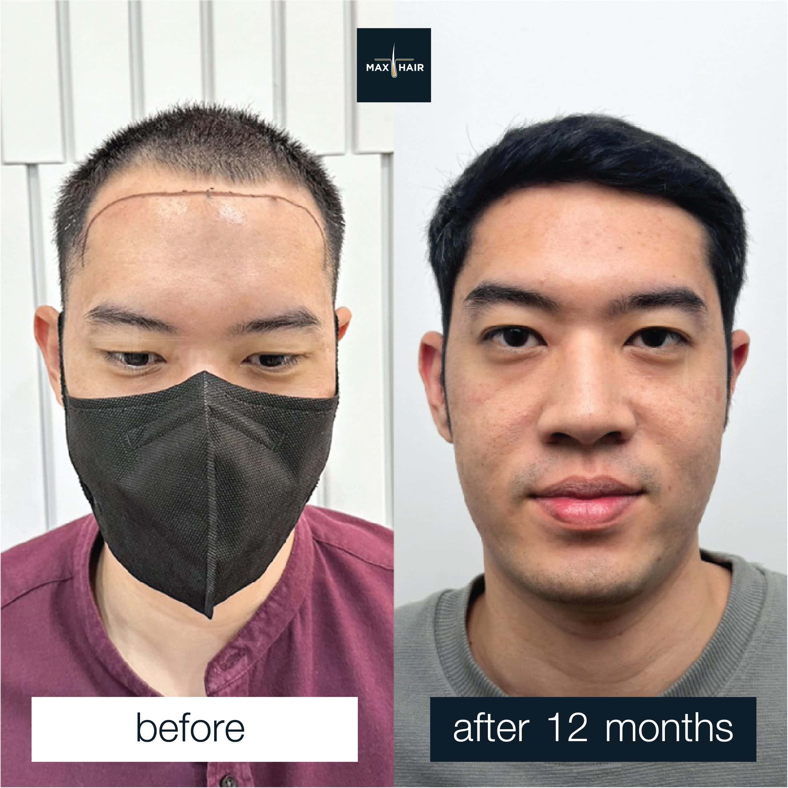 Before and after MCG 2,150 grafts hair transplant in a man, 12 months result