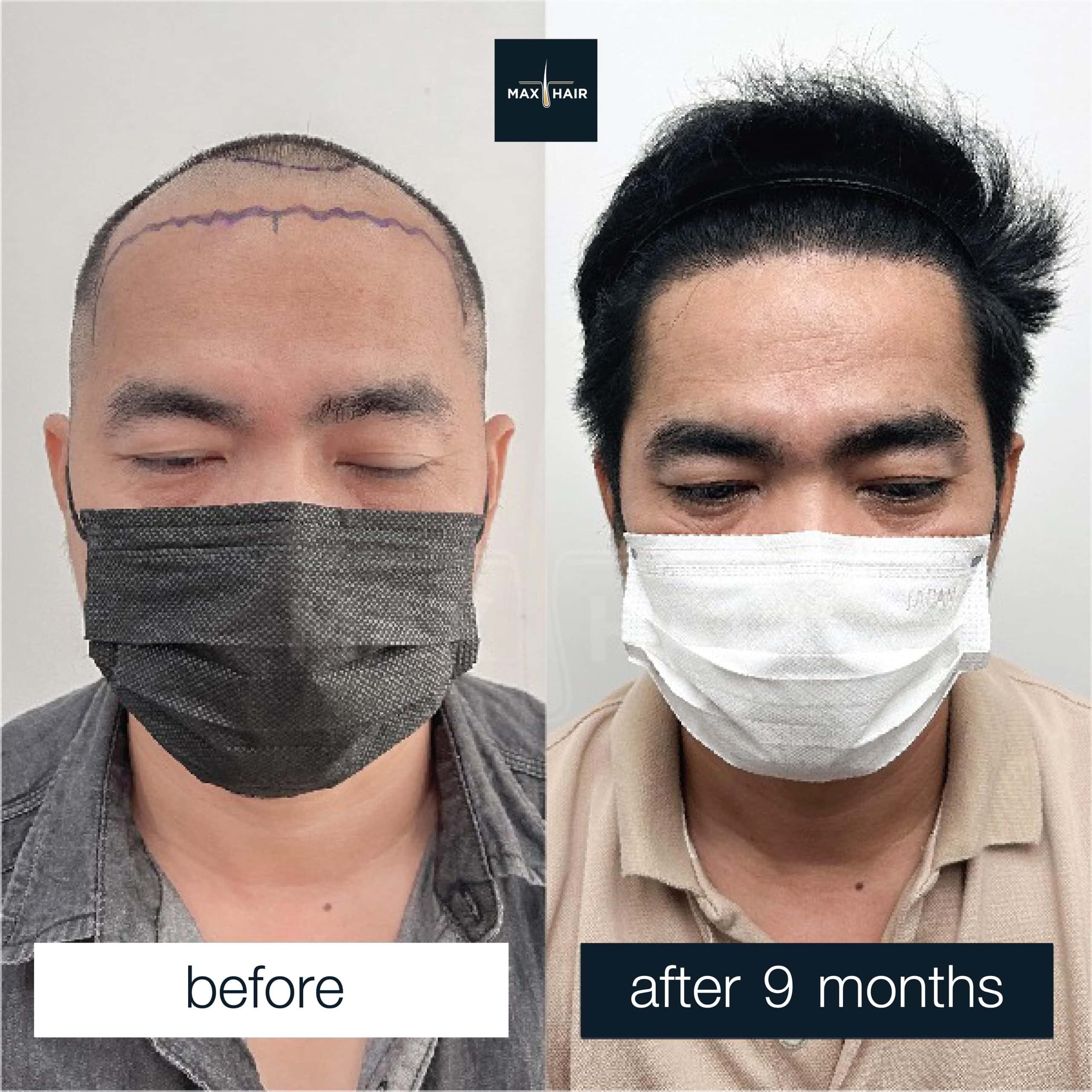 Hair transplant before after comparison showing male patient - Max Hair case review