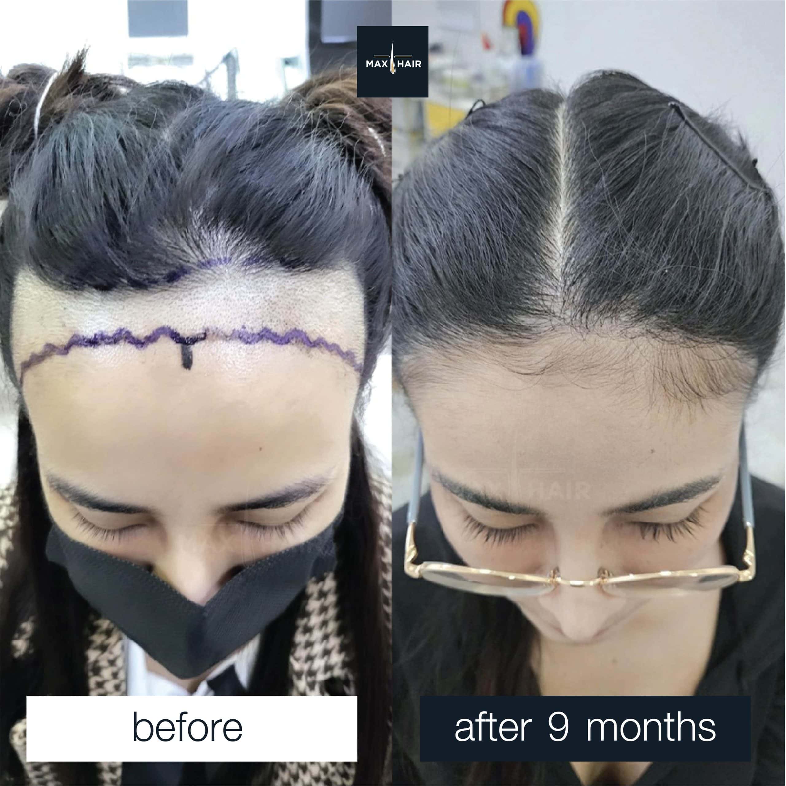 Hair transplant before and after 9 months in woman with receding hairline and wide forehead.