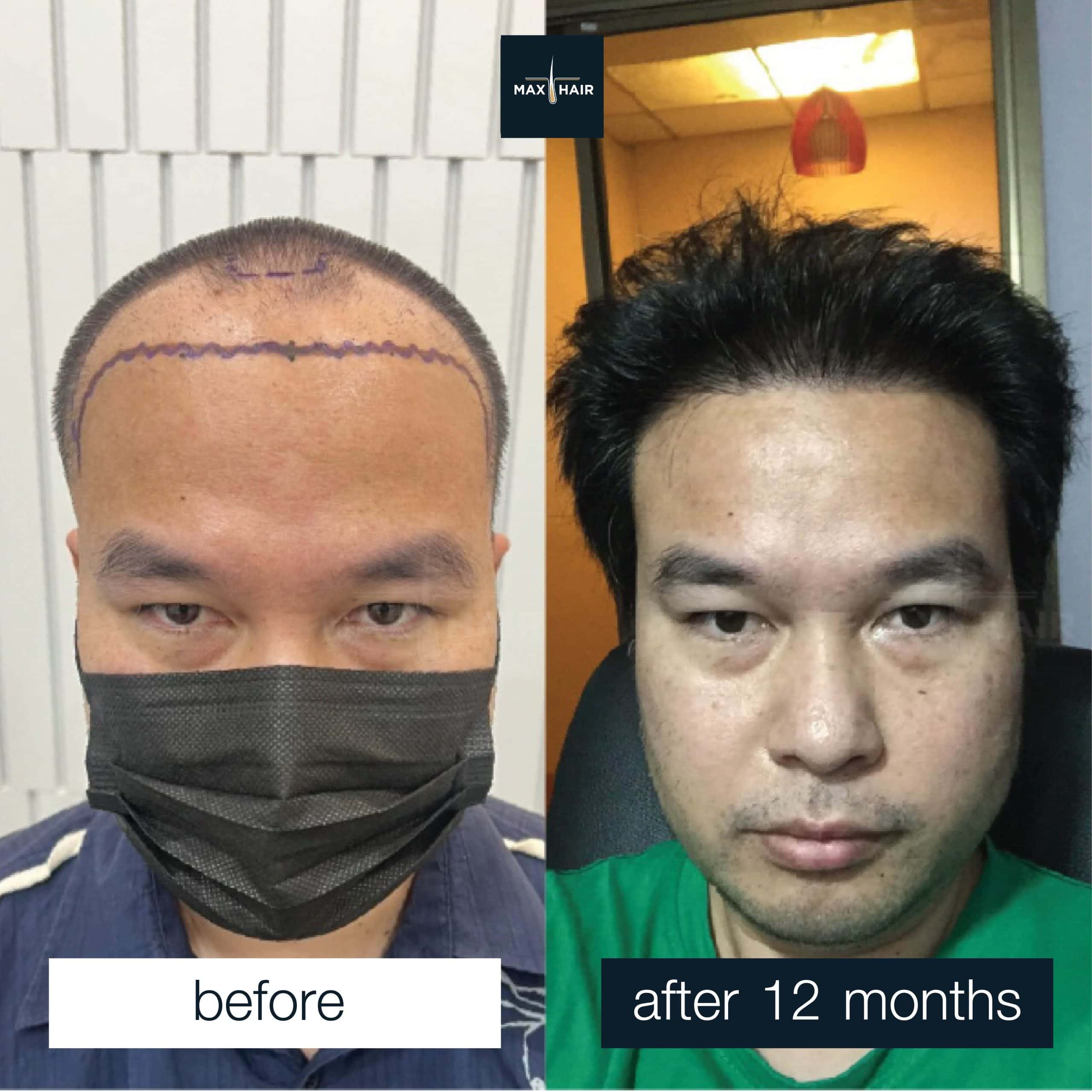 Male hair transplant results MCG 3,100 grafts after 12 months