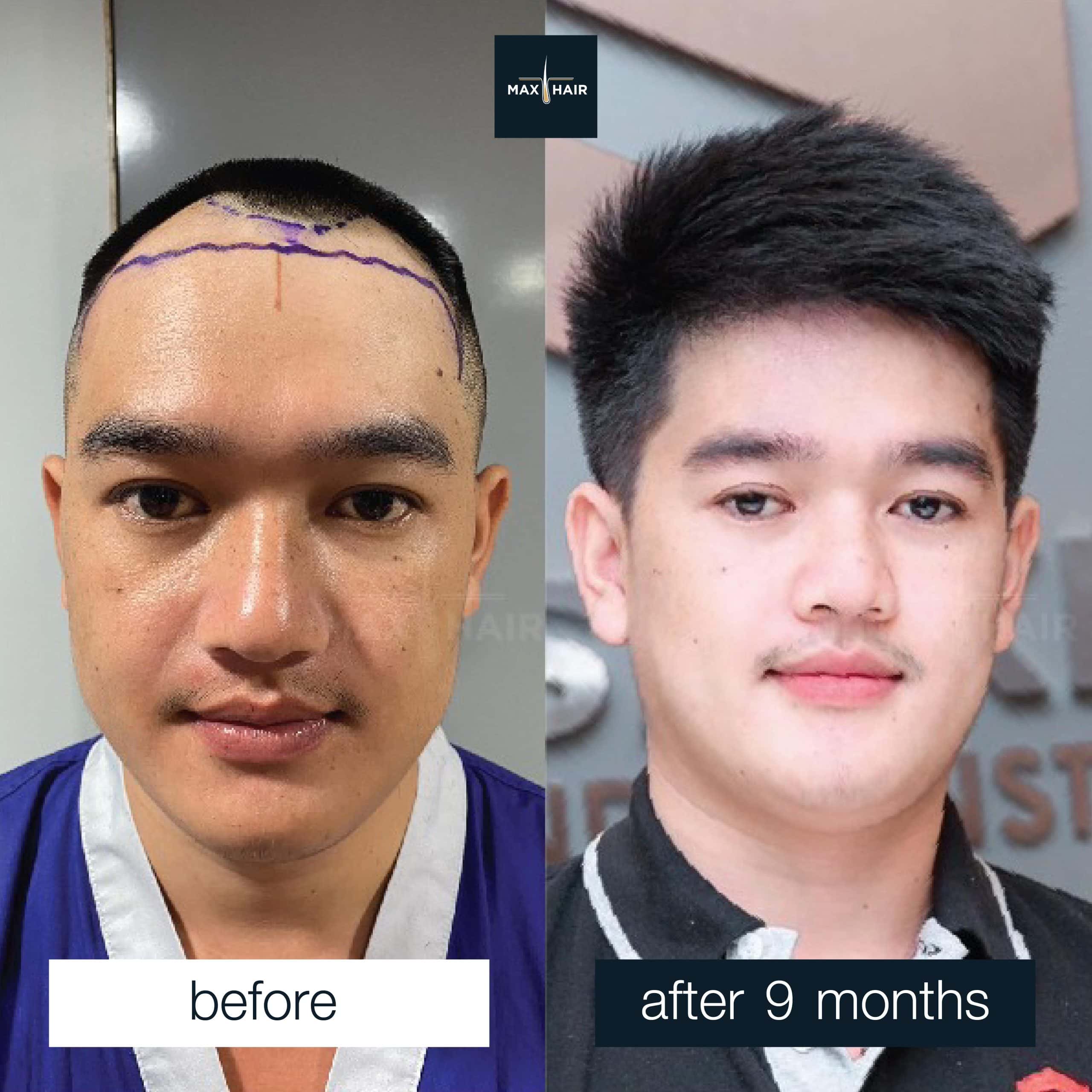 Before and after MCG 2,800 grafts hair transplant in a man, 9 months result