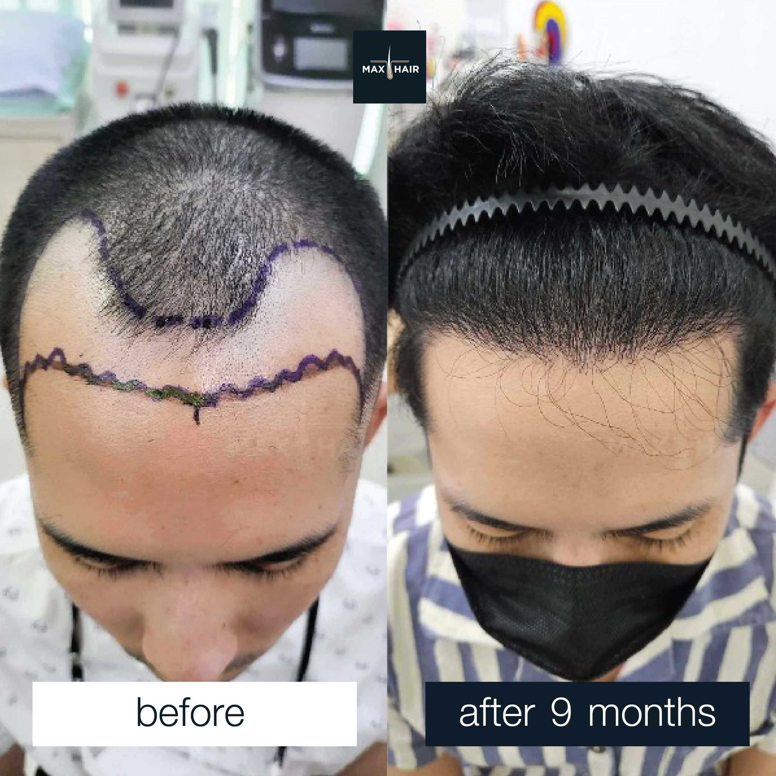 Real male hair transplant case reviews showing successful outcomes