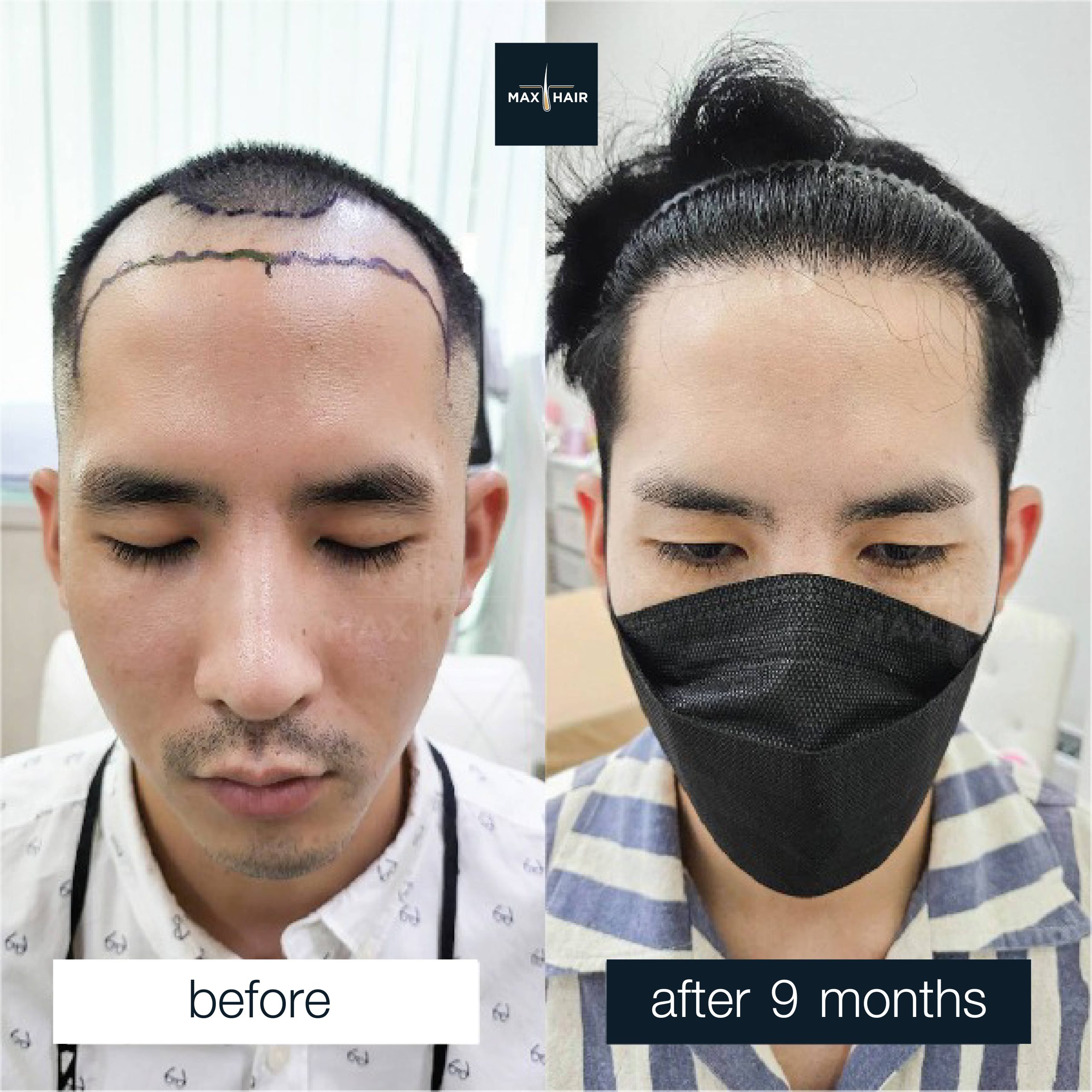Hair Transplant Case Reviews - Men