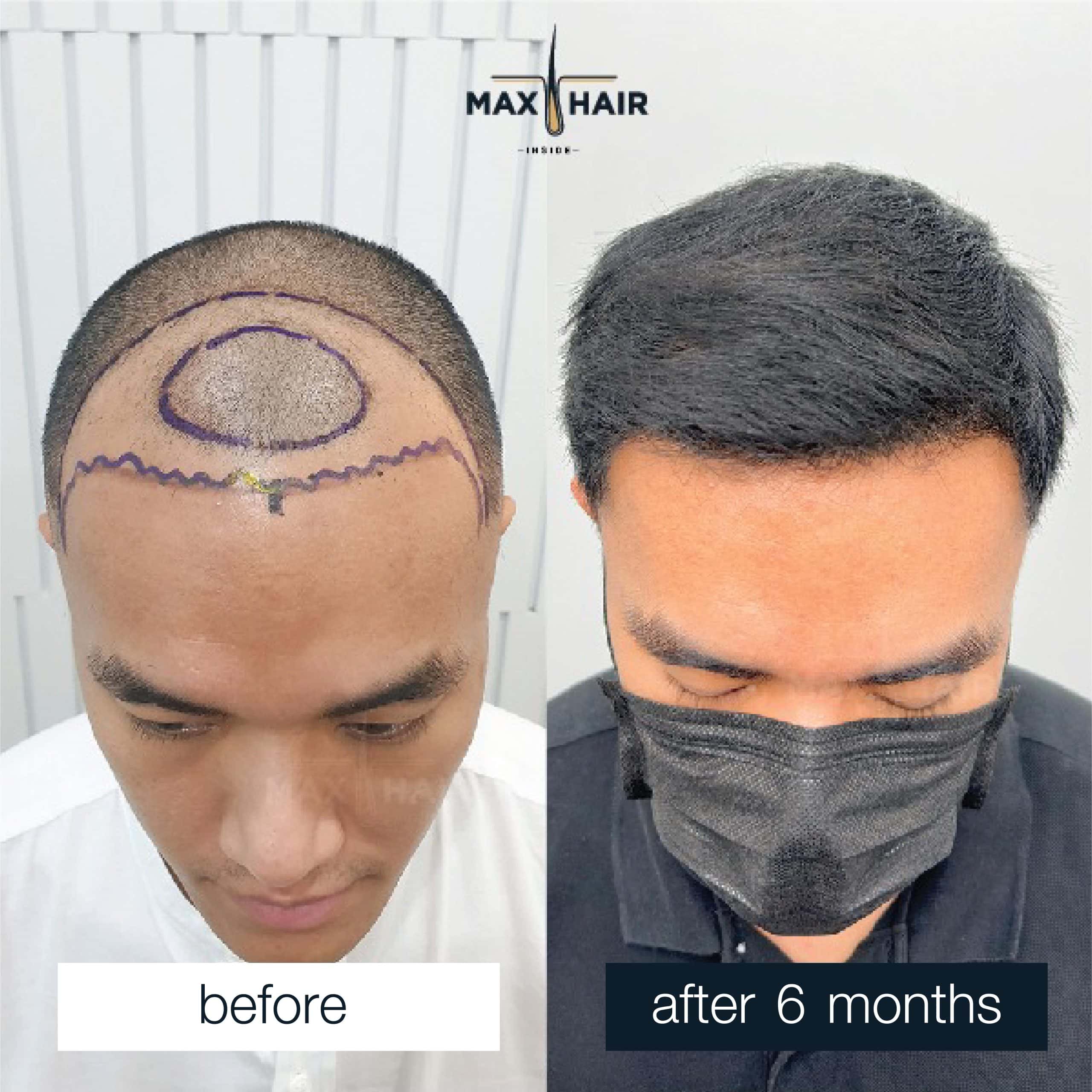 Hair transplant MCG 2,900 grafts results after 6 months