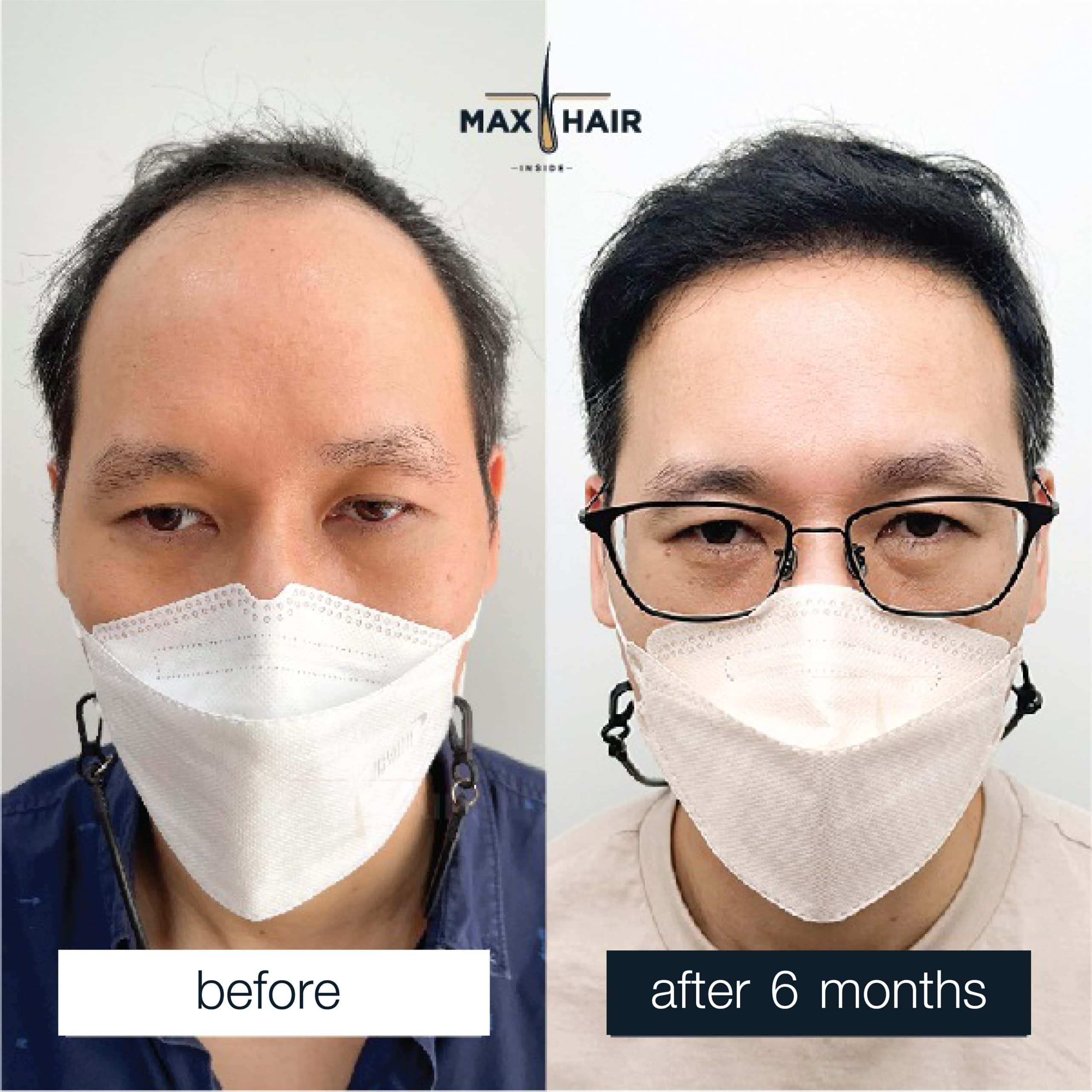 Men's hair transplant review case: MCG technique, 3,200 grafts