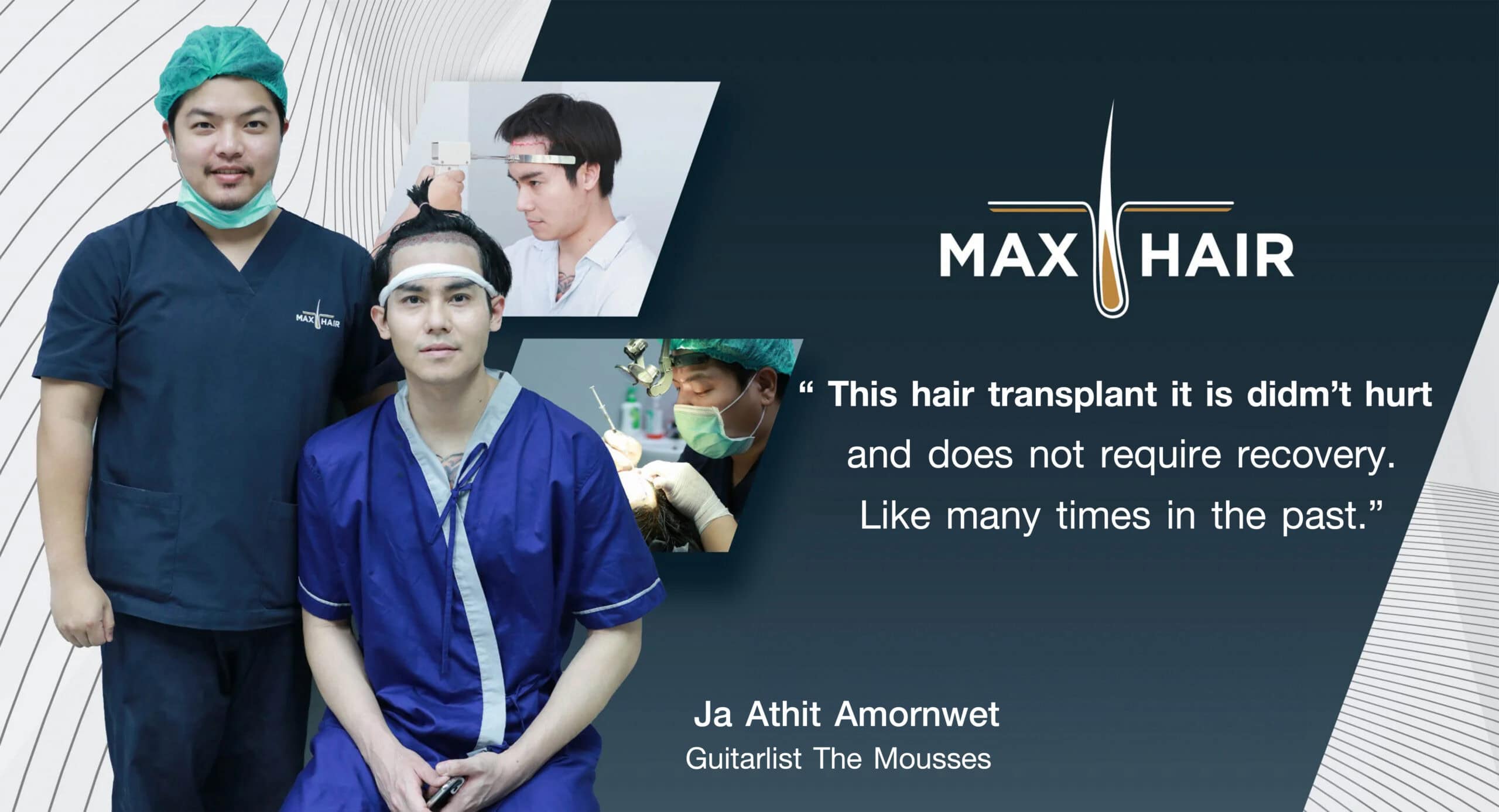 Ja Athit after hair transplant at Max Hair Clinic