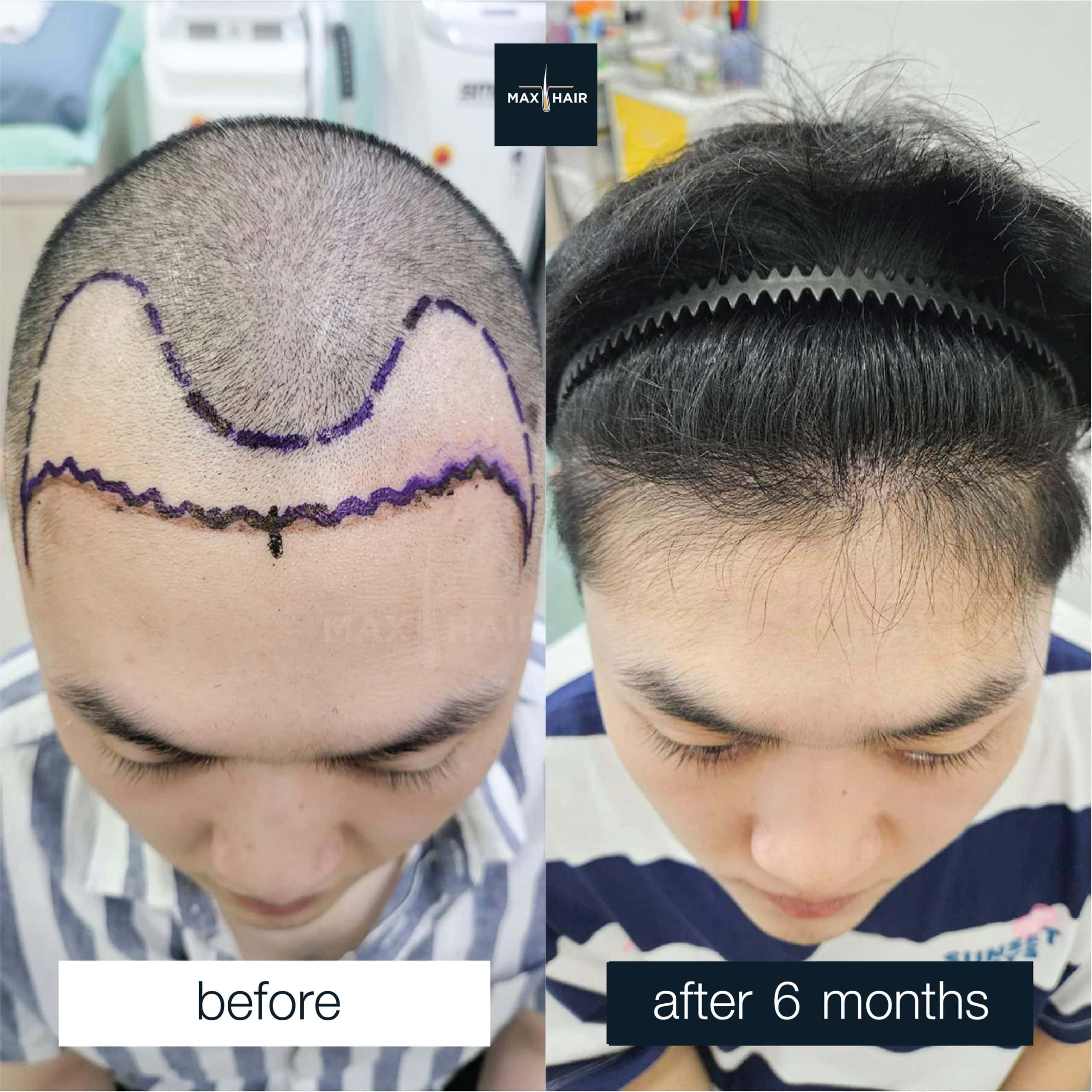 Browse all real male hair transplant case reviews and results Max Hair Clinic