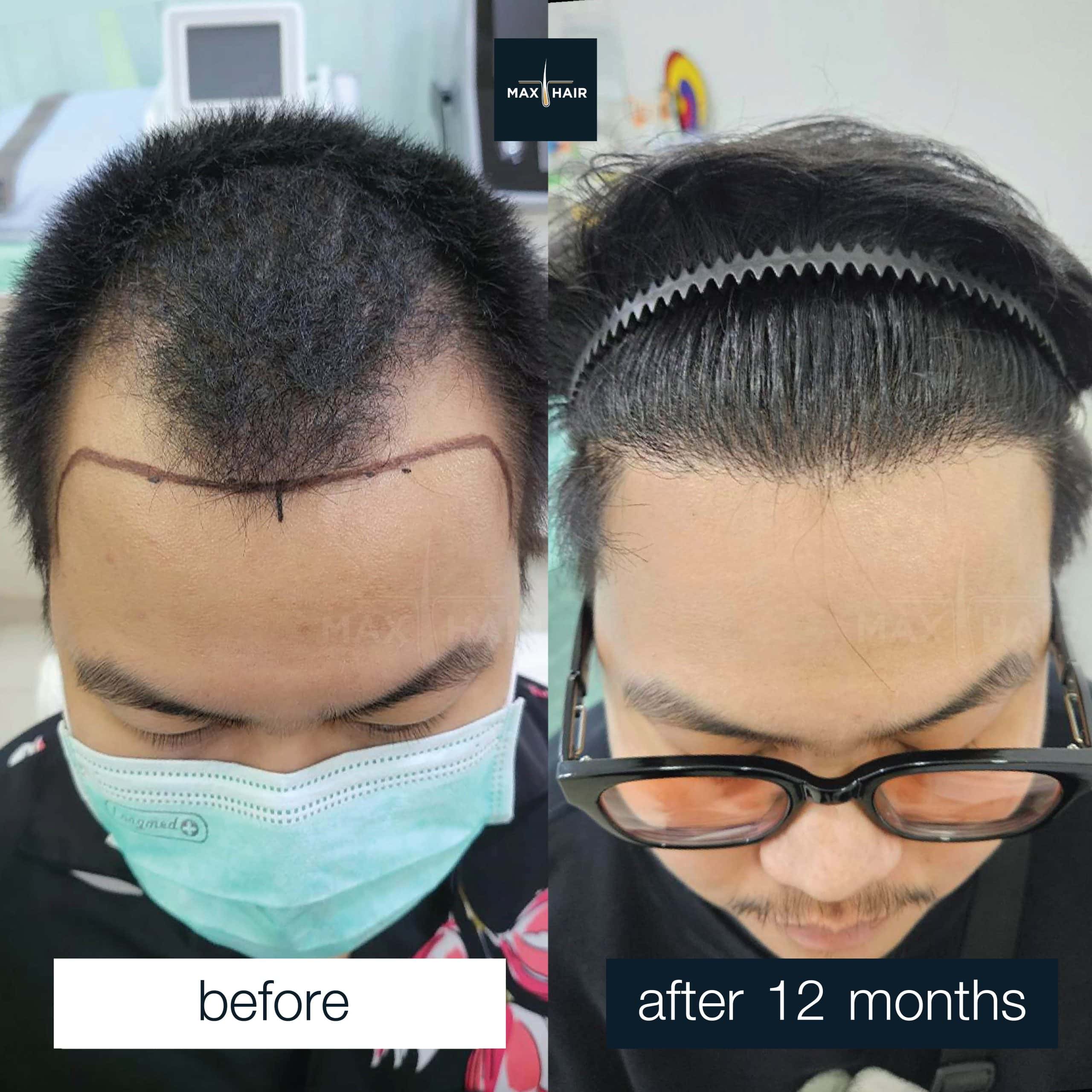 Successful hair transplant recovery with natural-looking hair