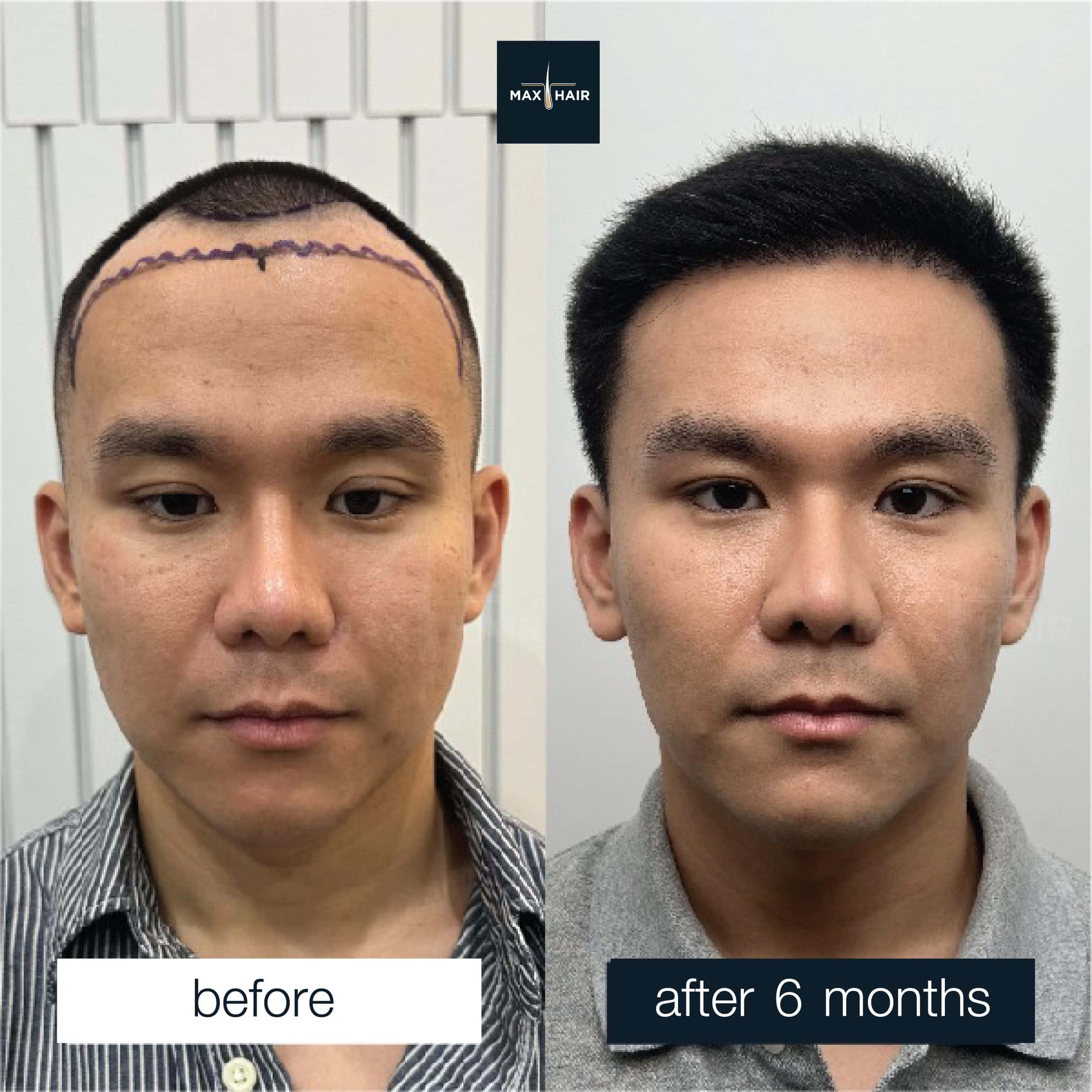 Close-up of restored hairline after hair transplant procedure