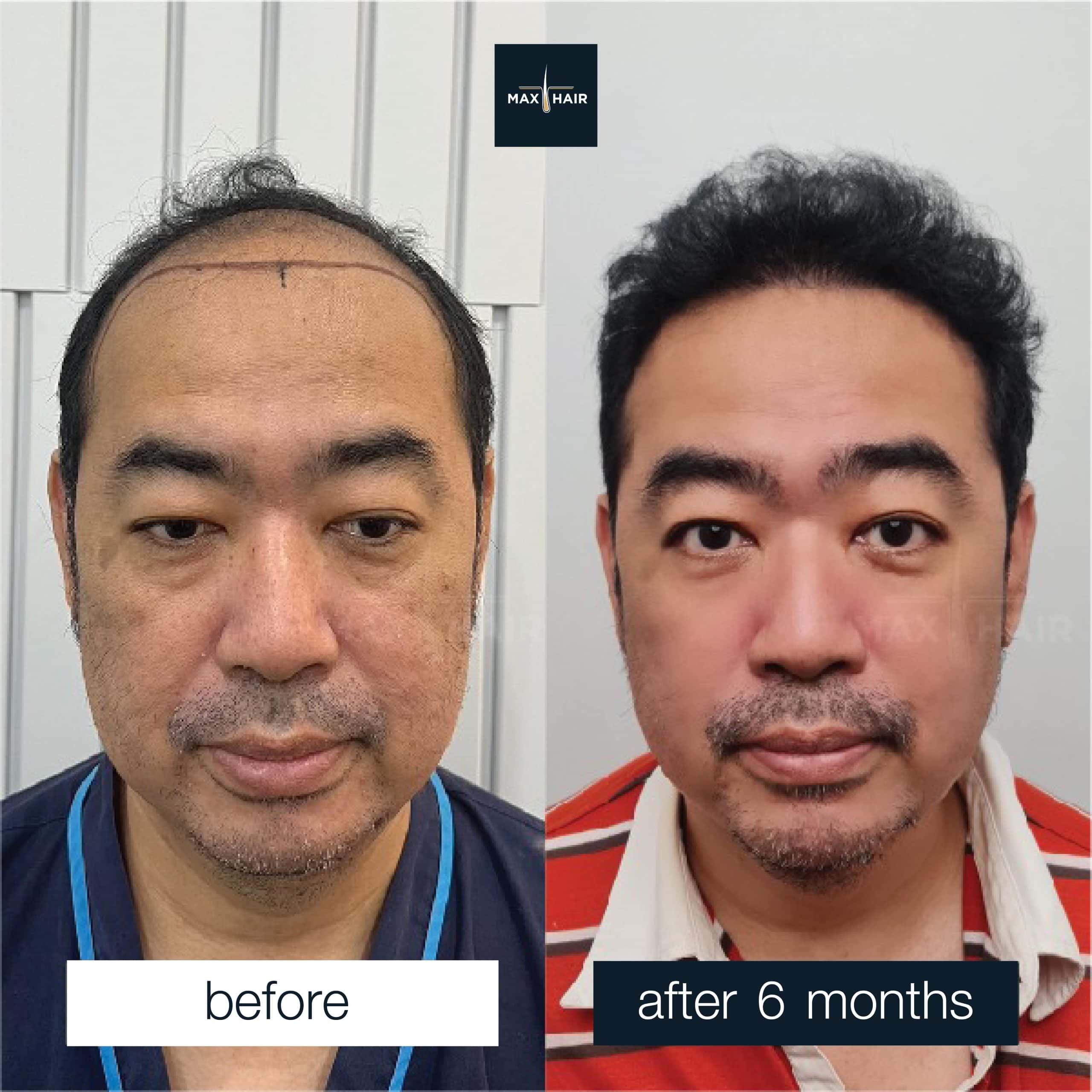 Hair transplant results after 6 months in a man with severe hair loss.
