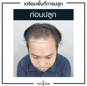 ตัวอย่างการเตรียมพื้นที่การปลูกม