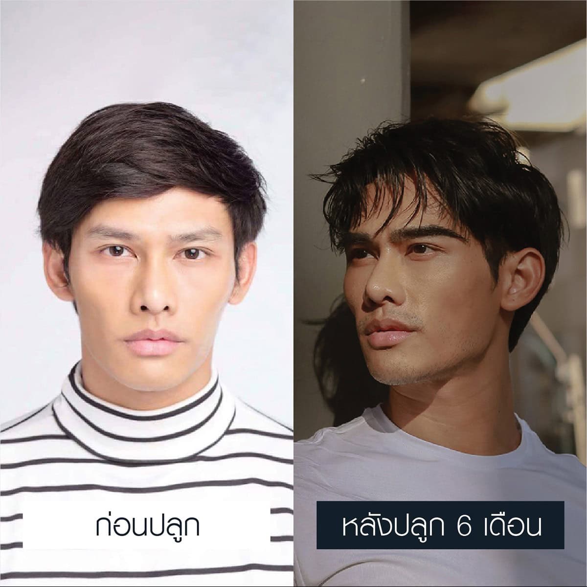 รีวิวปลูกคิ้ว เชื่อมั่นได้ - Max Hair (7)