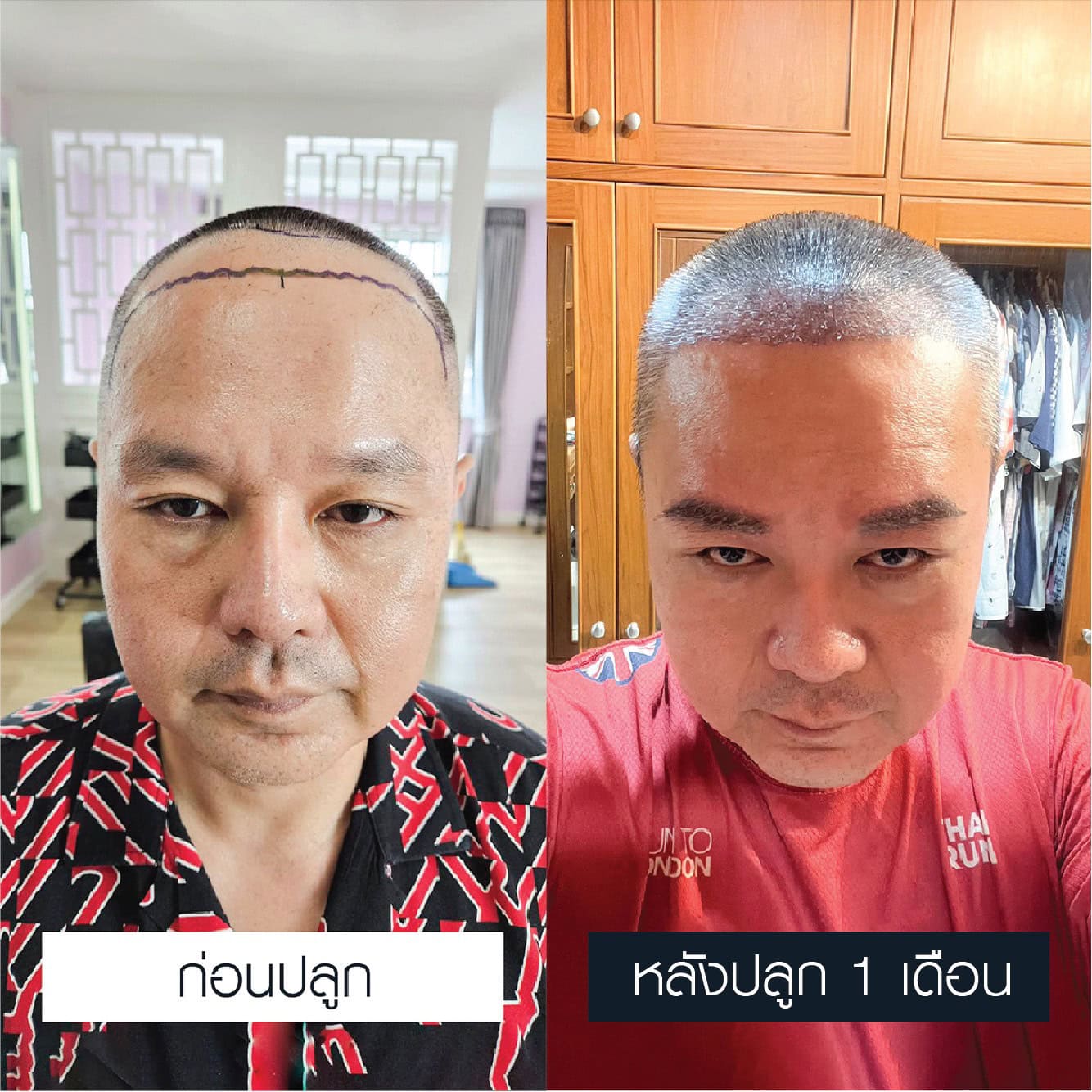 เปรียบเทียบก่อนและหลังผ่านไป 1 เดือนของการปลูกคิ้วผู้ชาย 600 กราฟต์
