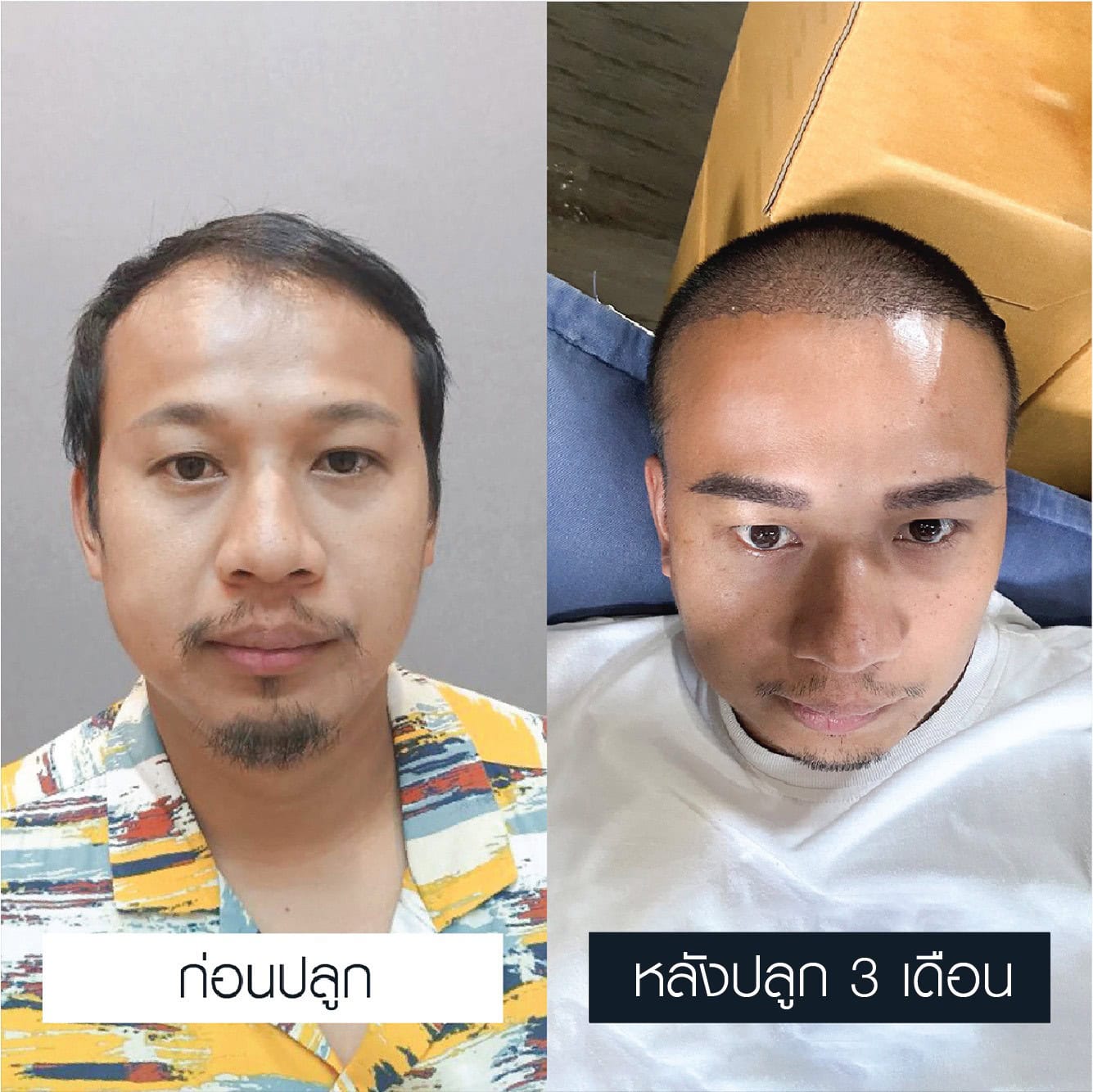 เปรียบเทียบก่อนและหลังผ่านไป 3 เดือน การปลูกคิ้วผู้ชาย 600 กราฟต์