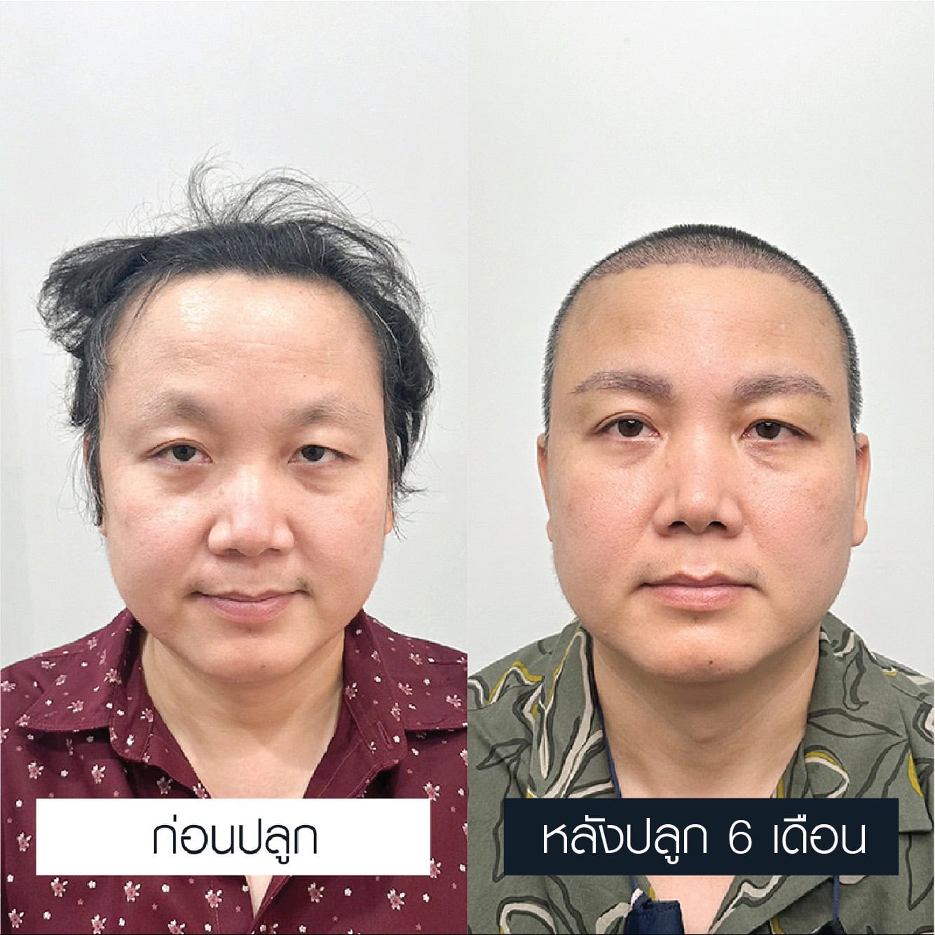 รีวิวการปลูกคิ้วสำหรับผู้ชาย ผลลัพธ์ก่อนและหลังทำ 6 เดือน