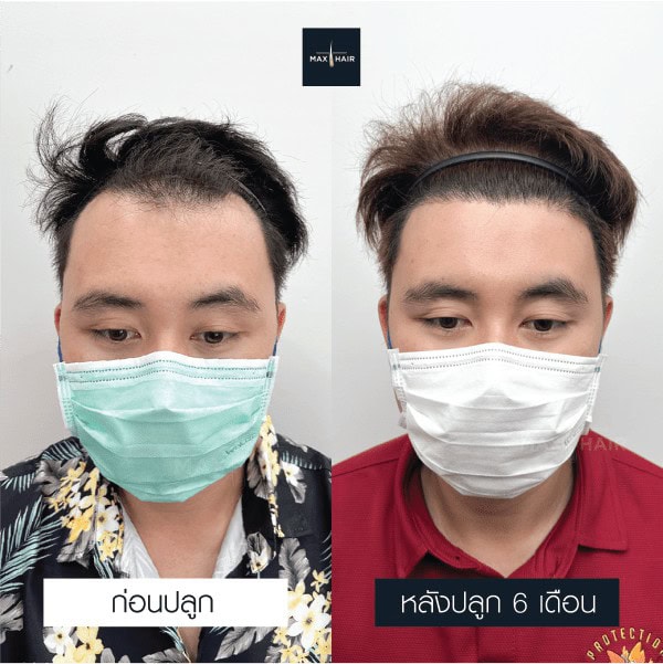 รีวิวปลูกผมผู้ชาย - Max Hair (6)