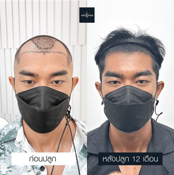 รีวิวปลูกผมผู้ชาย - Max Hair (5)