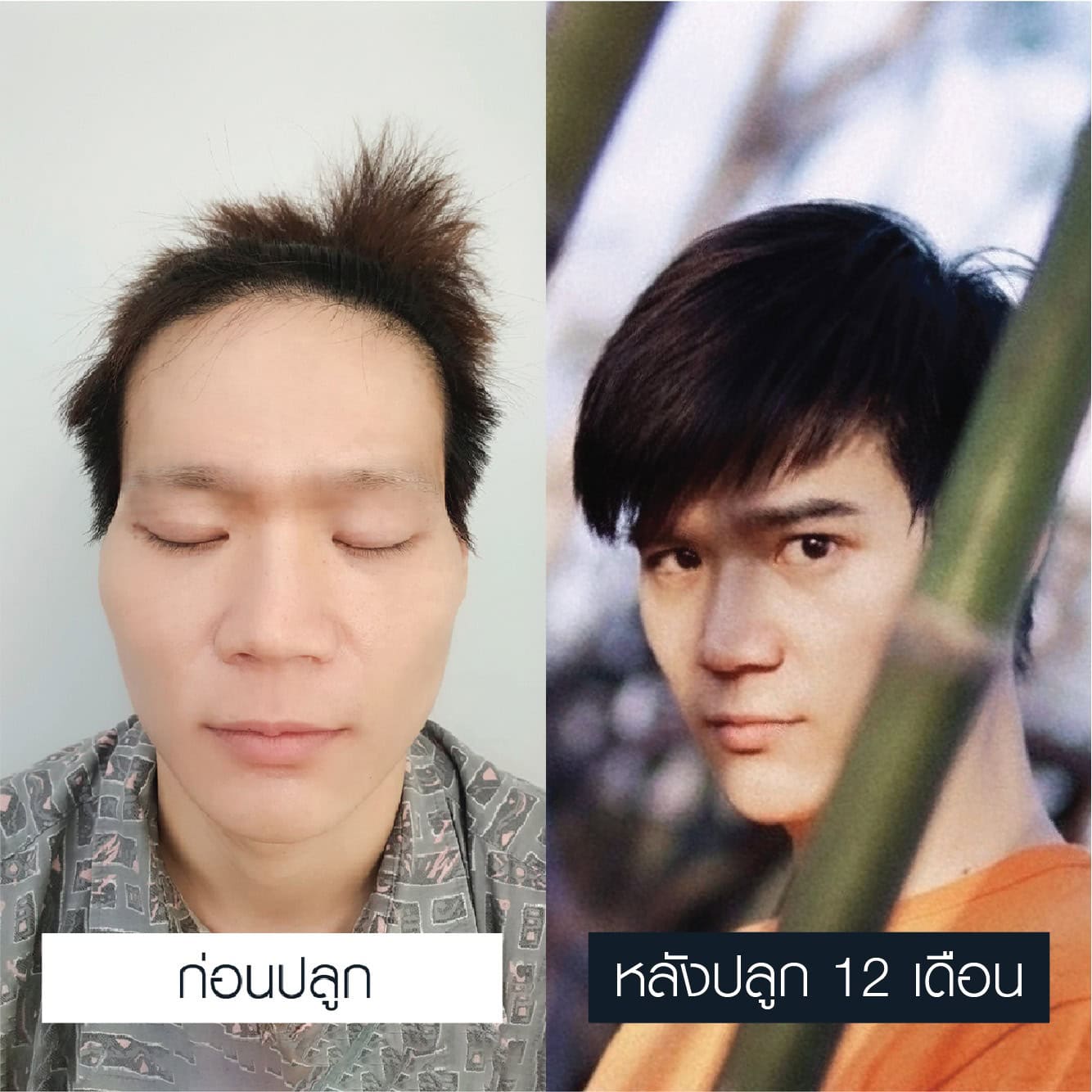 รีวิวปลูกคิ้ว เชื่อมั่นได้ - Max Hair (6)