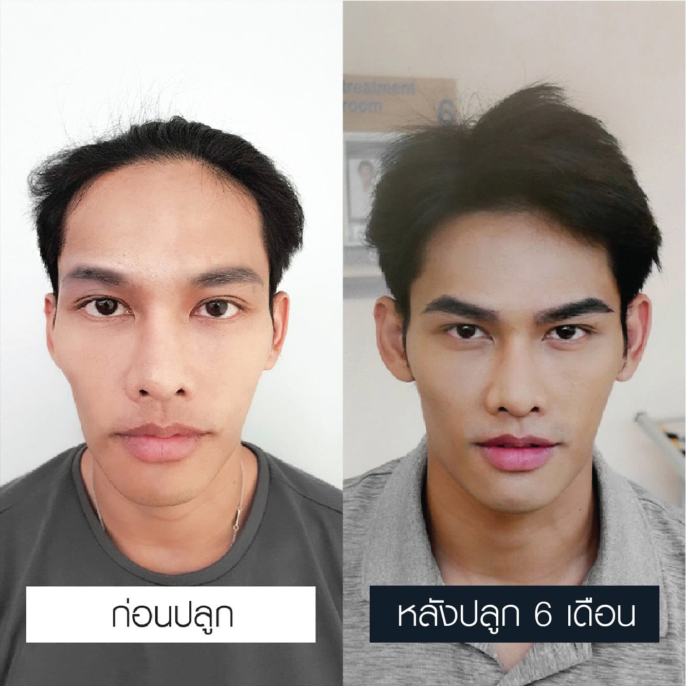 รีวิวปลูกคิ้ว เชื่อมั่นได้ - Max Hair (4)