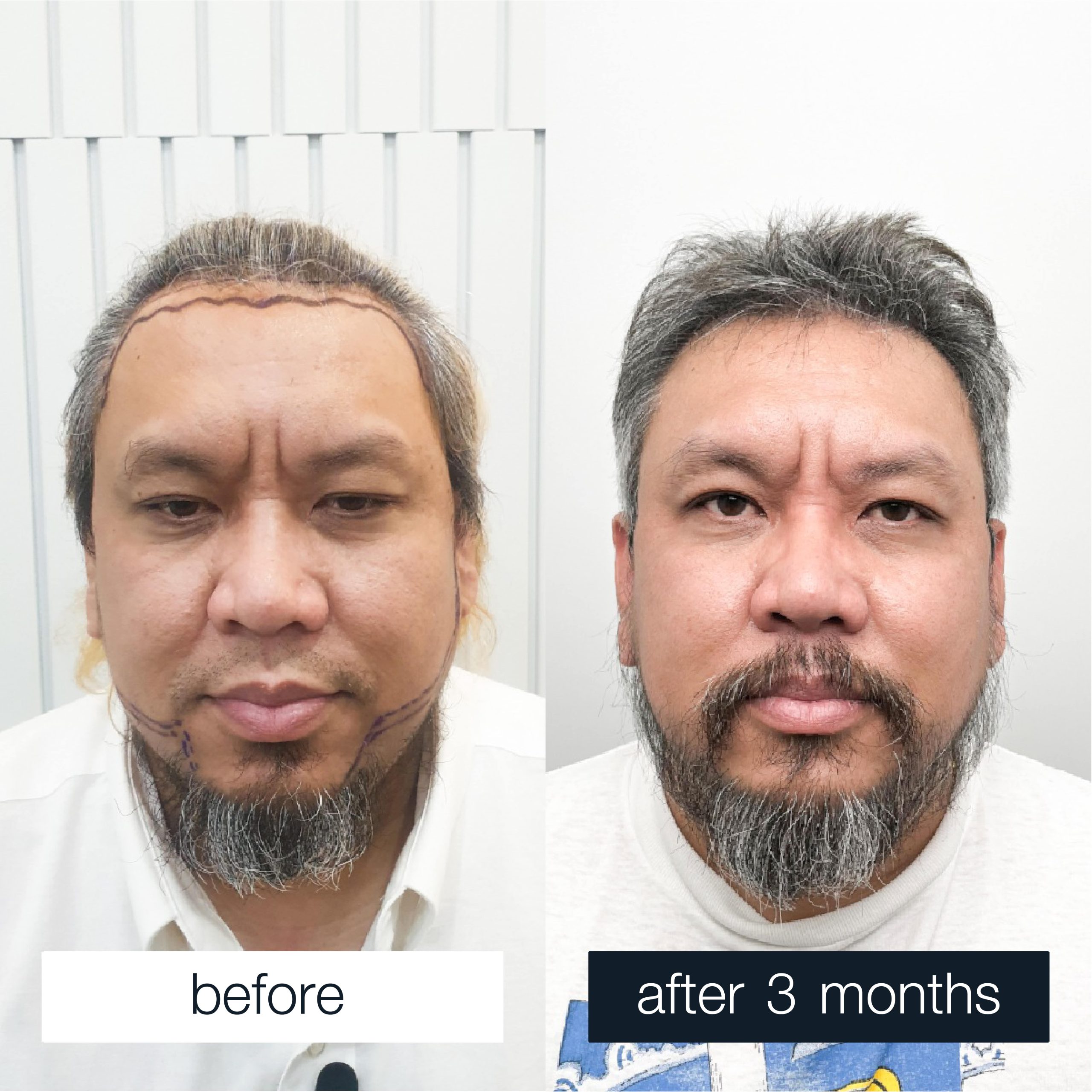 A man before and after a hair transplant procedure.