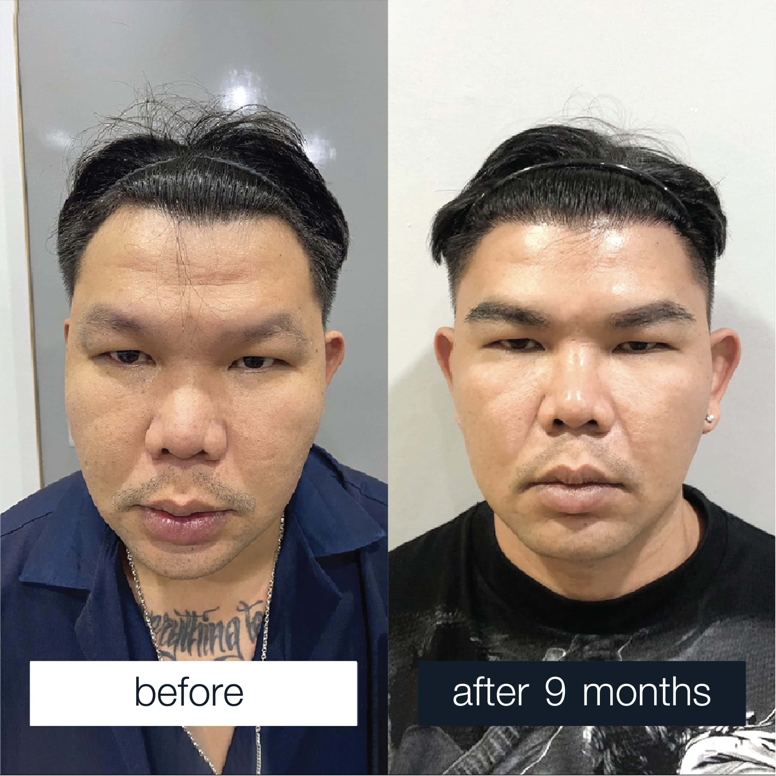 Men's eyebrow transplant review case: 600 grafts