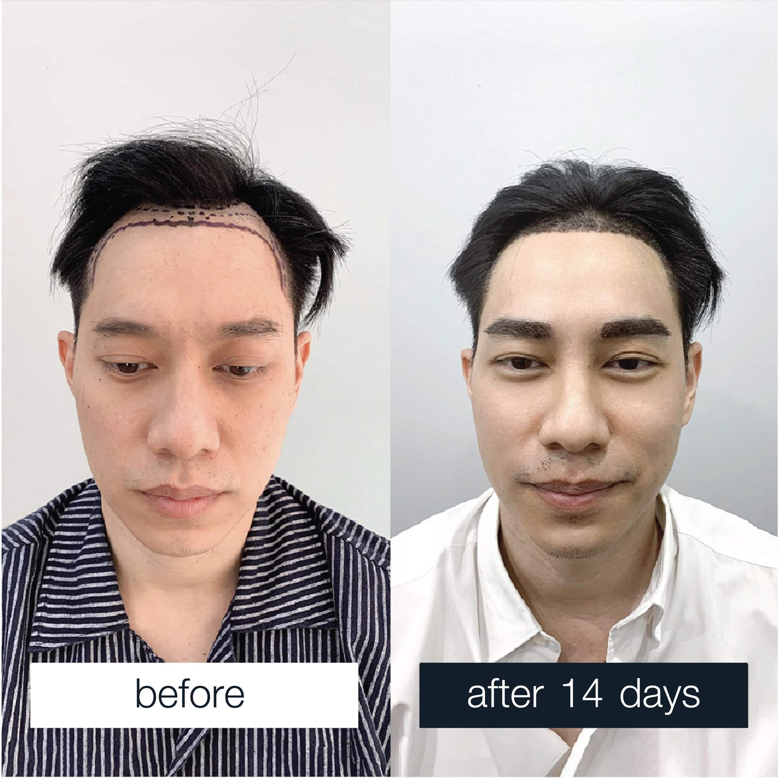 Before-and-after comparison of eyebrow transplantation results