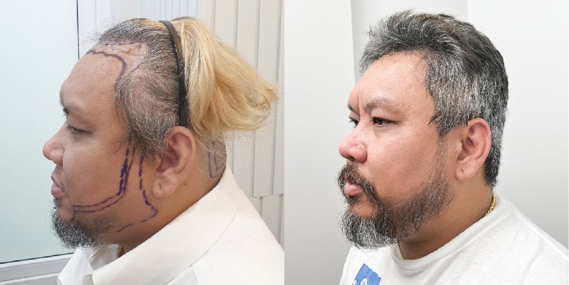 รีวิวปลูกเคราเพื่อปรับลุค เสริมความมั่นใจ