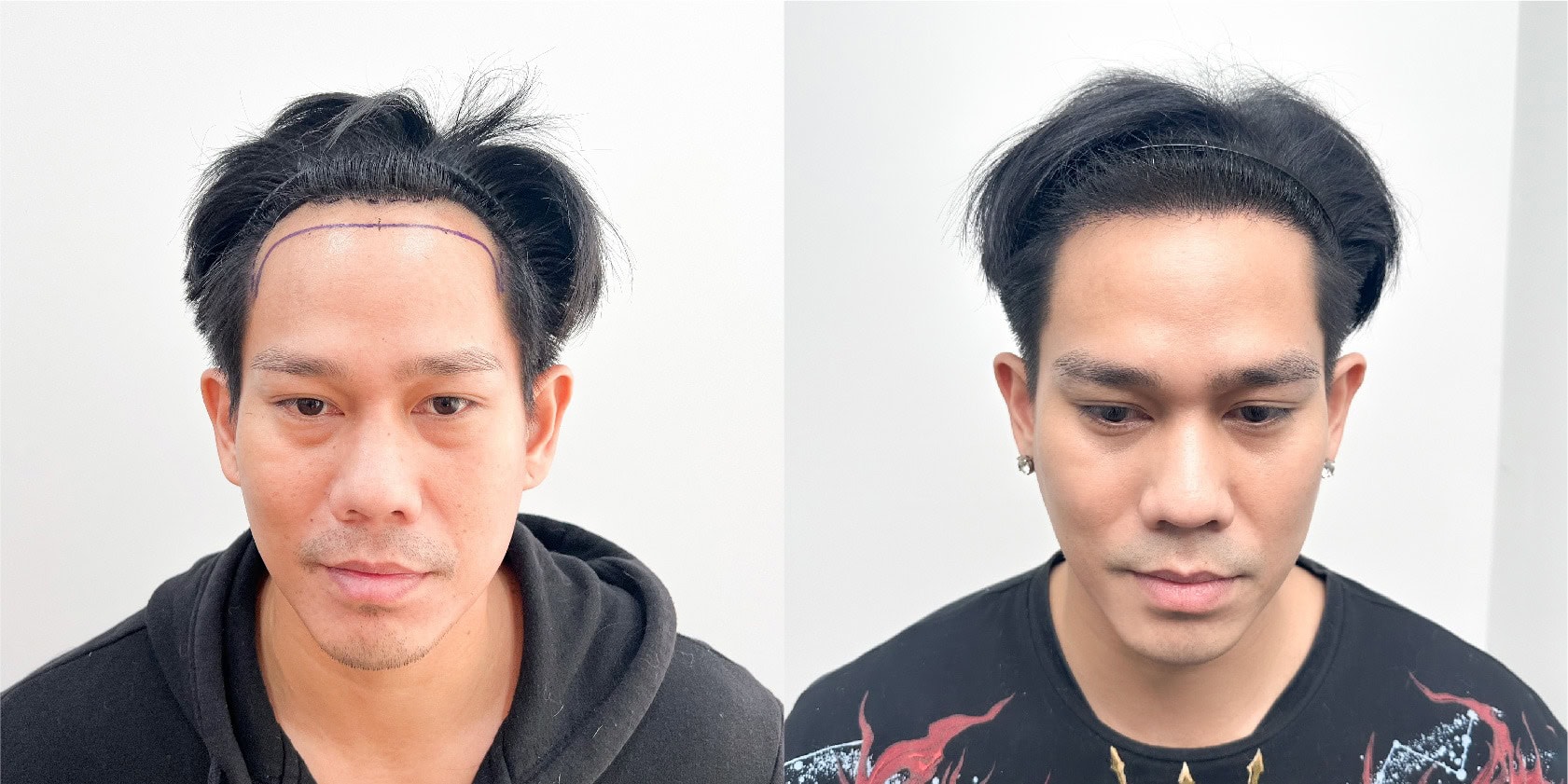 รีวิวการปลูกผมของคุณอาร์ เดอะสตาร์ (ศิลปิน / นักร้อง)