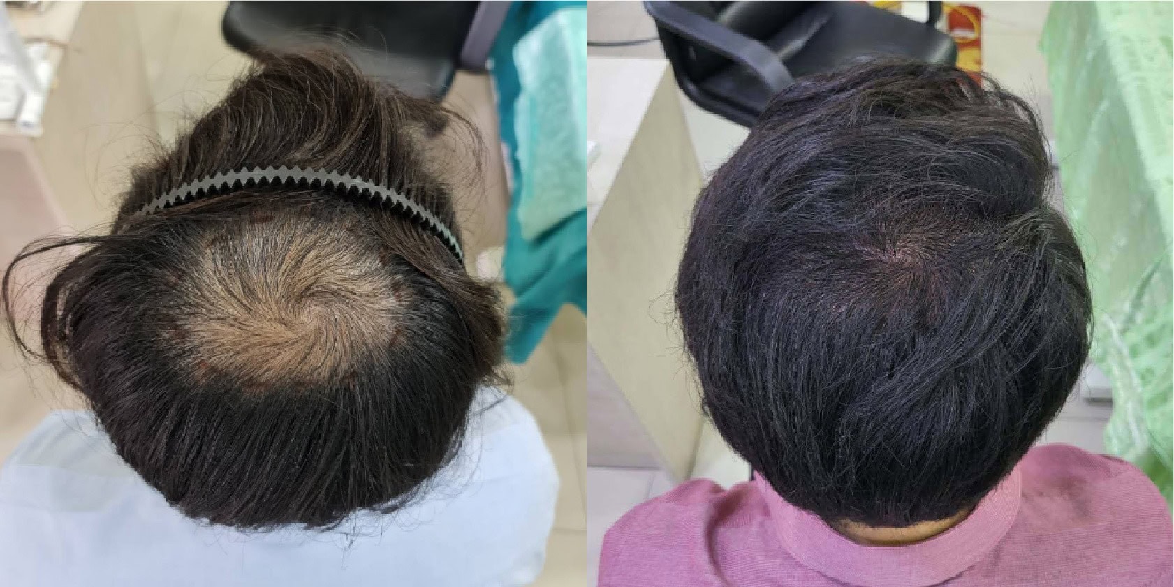 รีวิวการปลูกผมถาวร แก้ปัญหาผมบางที่ แม็กซ์แฮร์ คลินิก