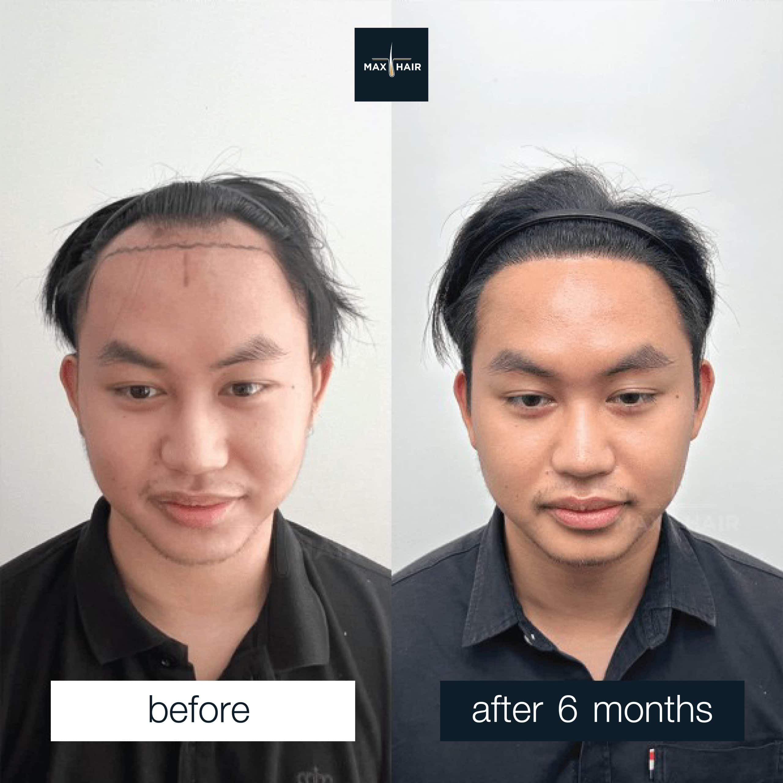 Hair transplant before and after 6 months.