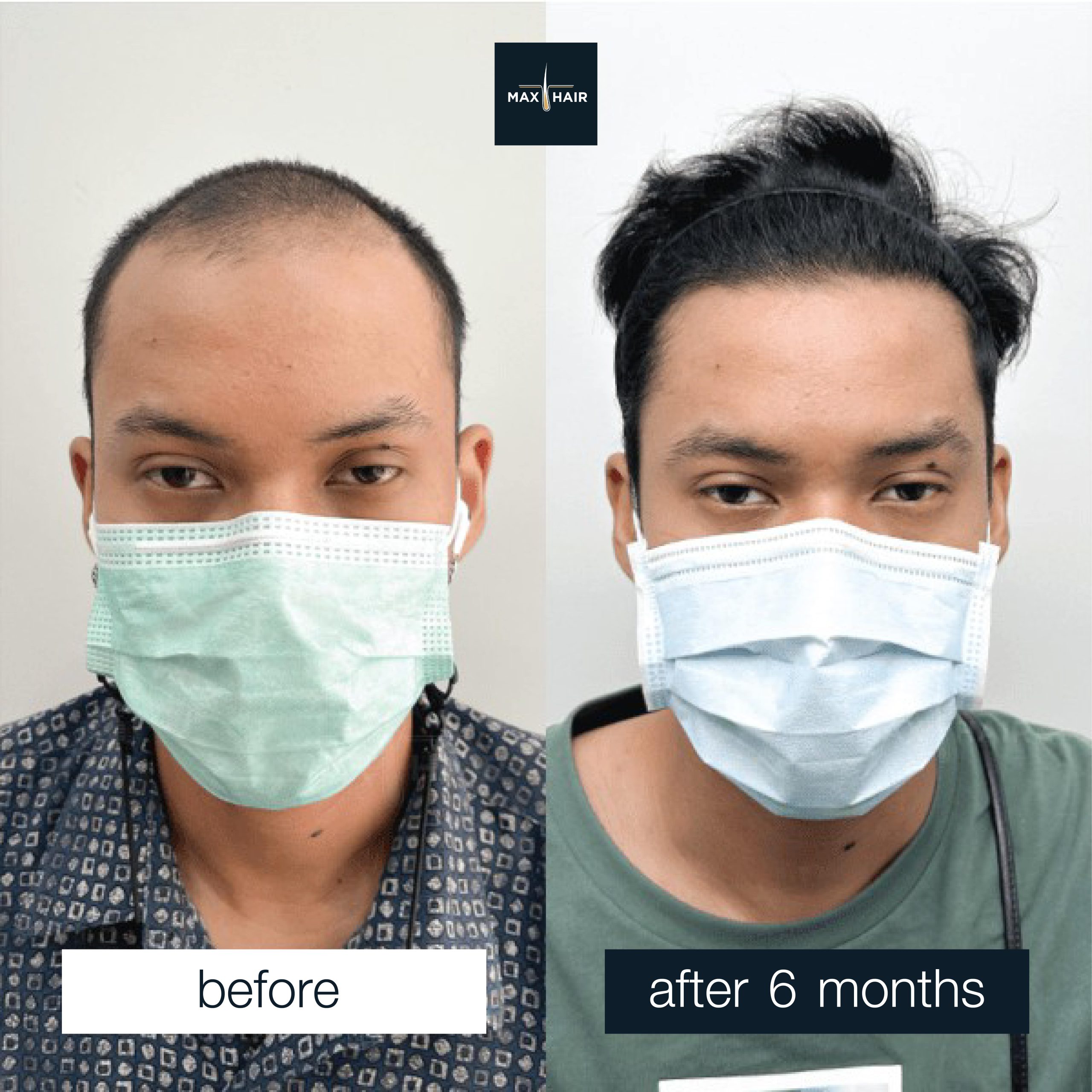 Comparison of a young man before and after a hair transplant.