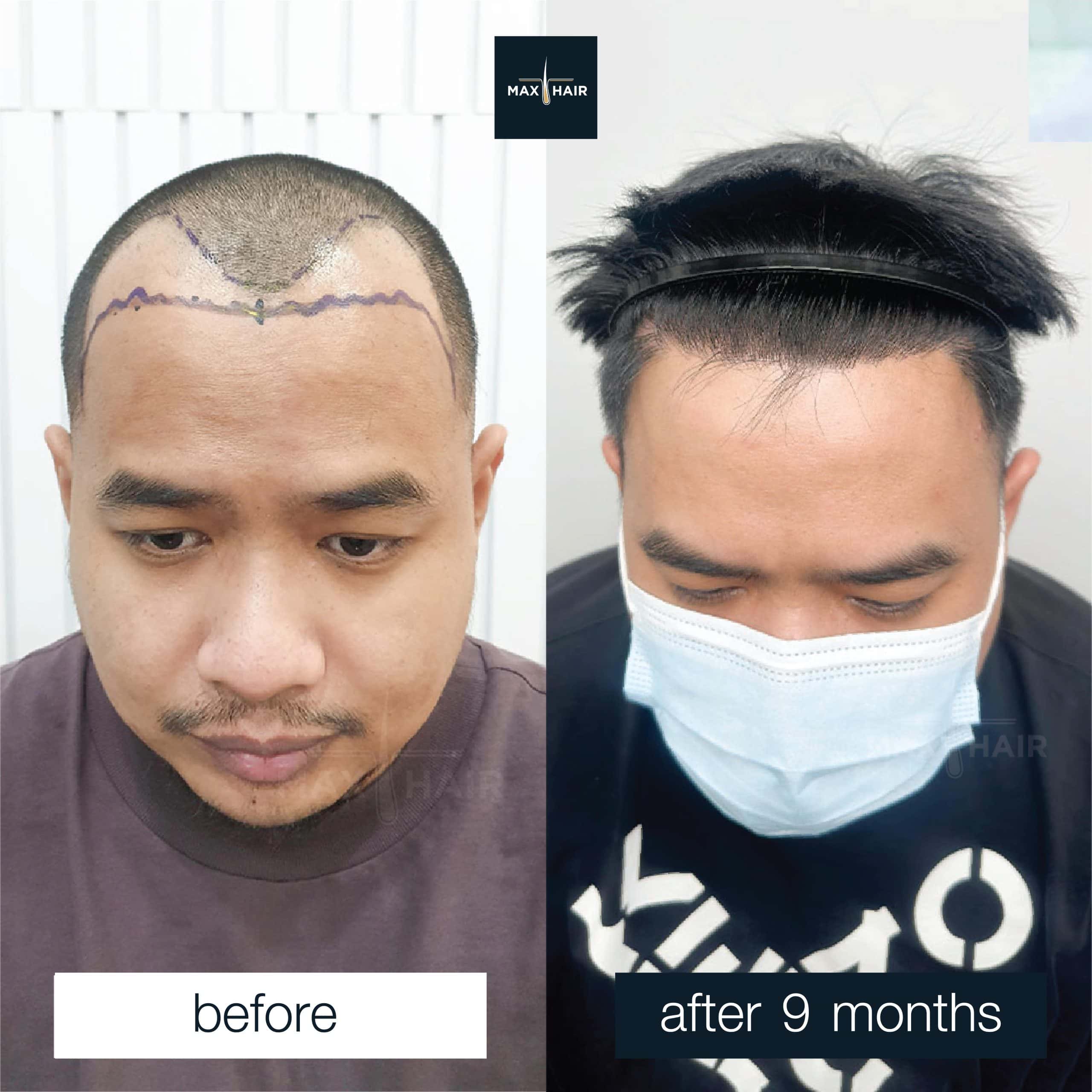 Male hair transplant results MCG 2,350 grafts after 9 months