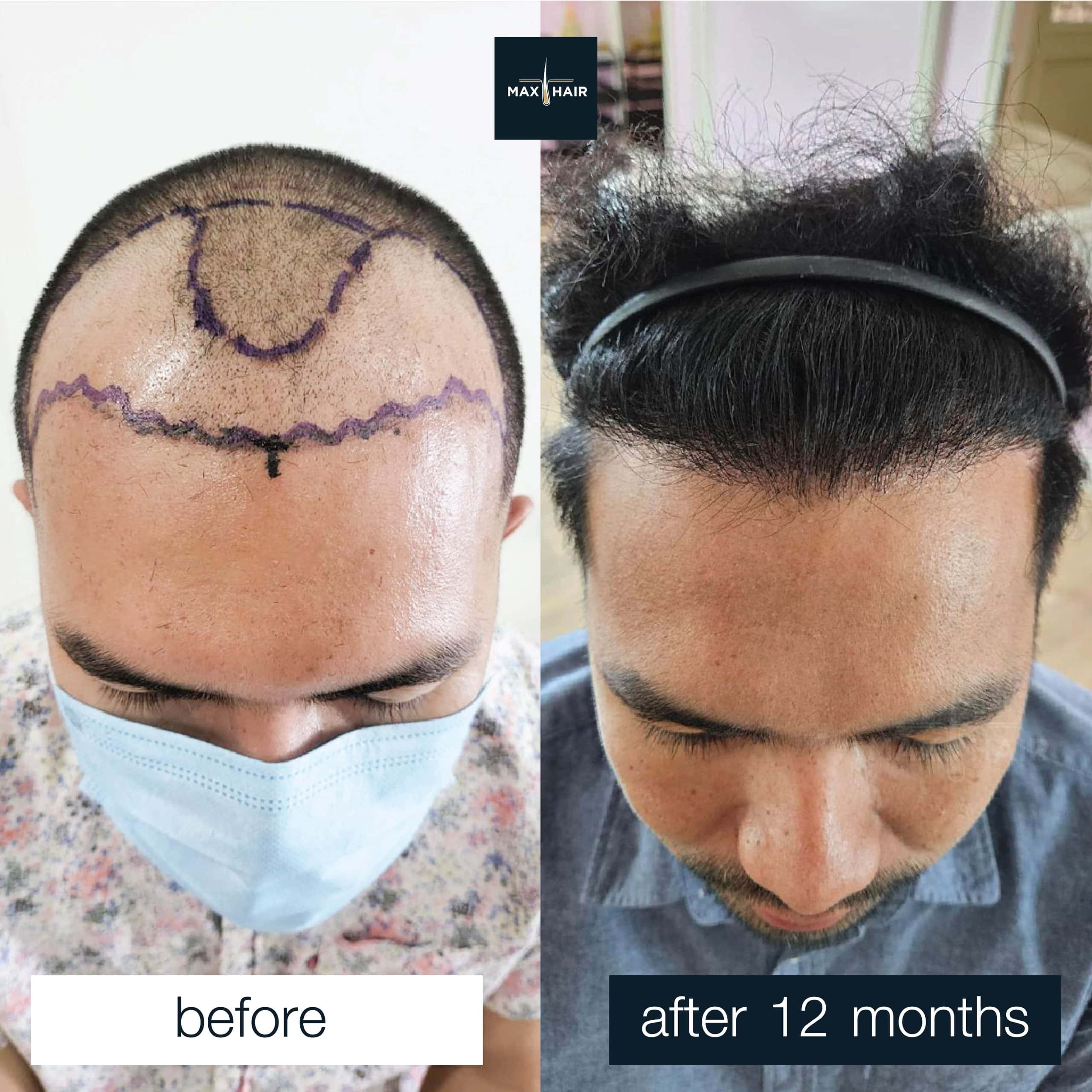 Men's permanent hair transplant case studies and transformation reviews