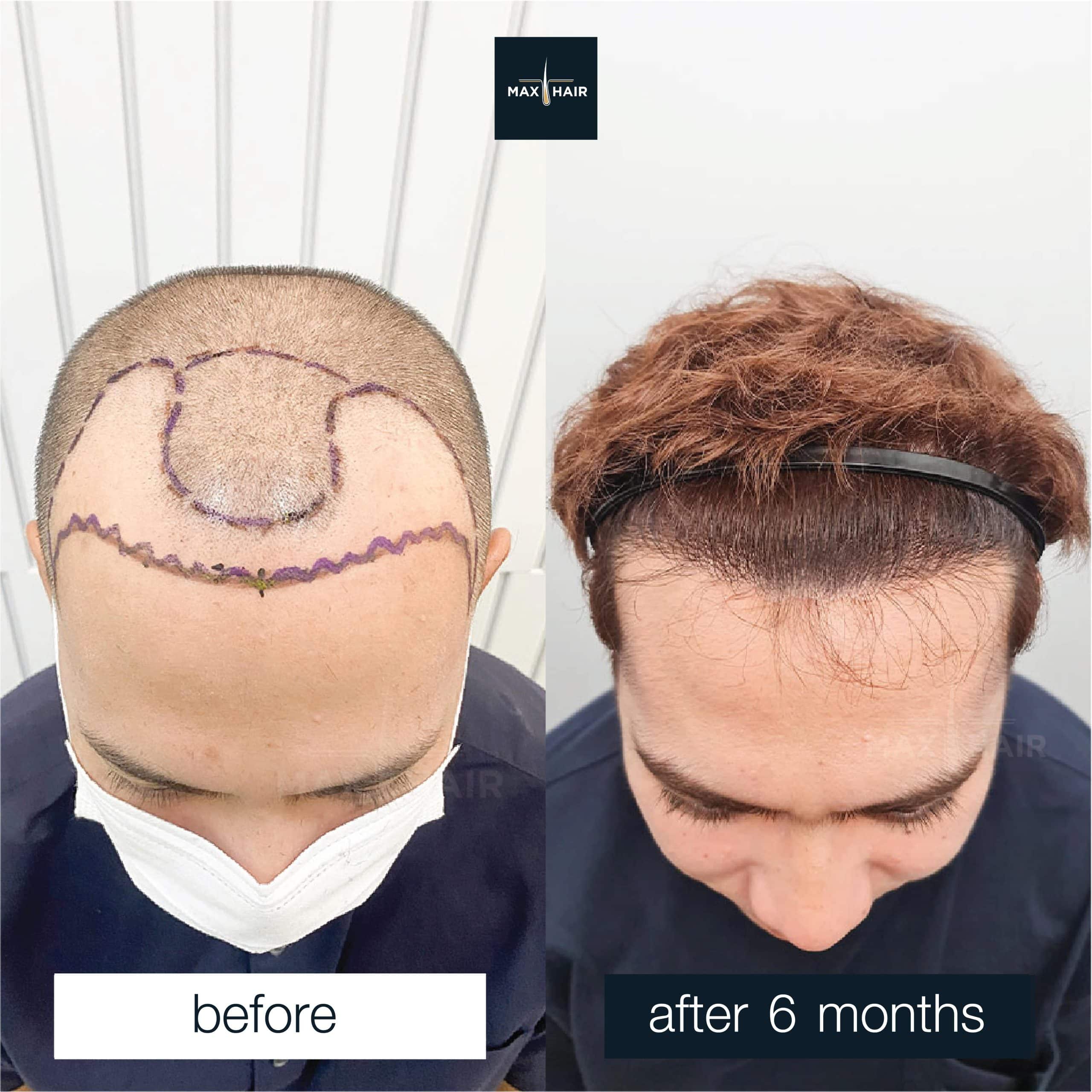 Before and after photos of male hair transplant patient - Max Hair real case review