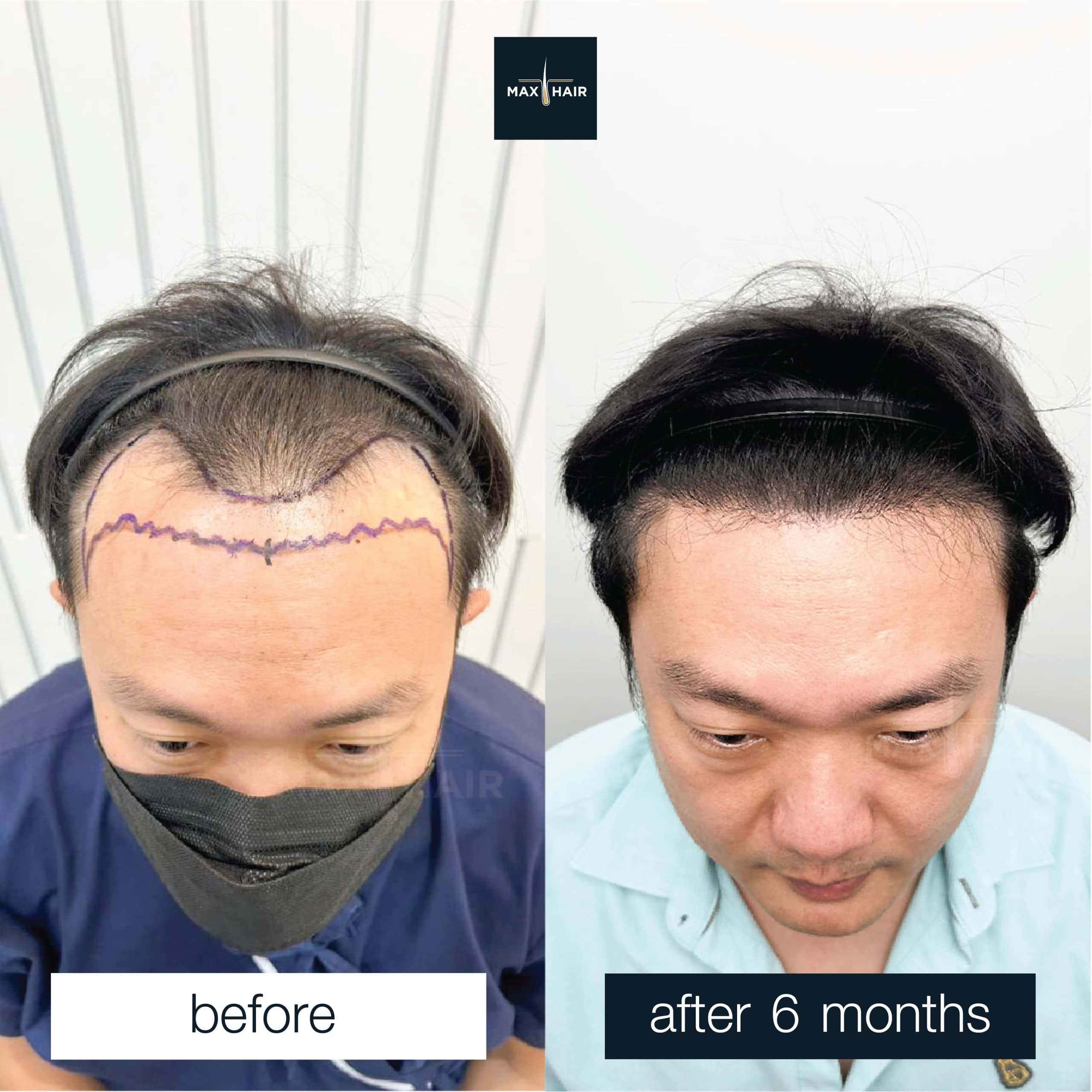 After a hair transplant, a man's hairline shows full regrowth at 12 months.