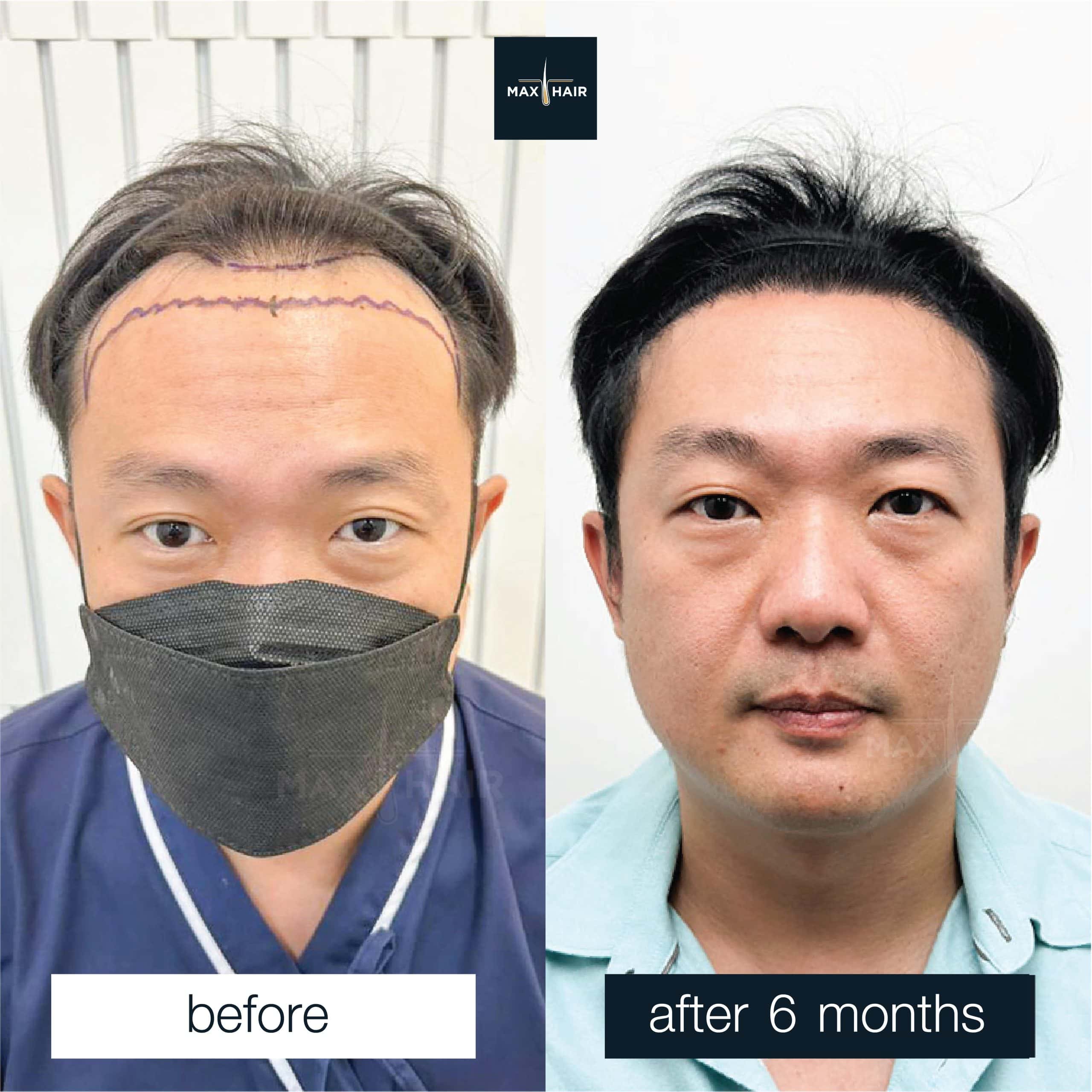 Hair transplant before and after 6 months in man showing restored natural hairline.