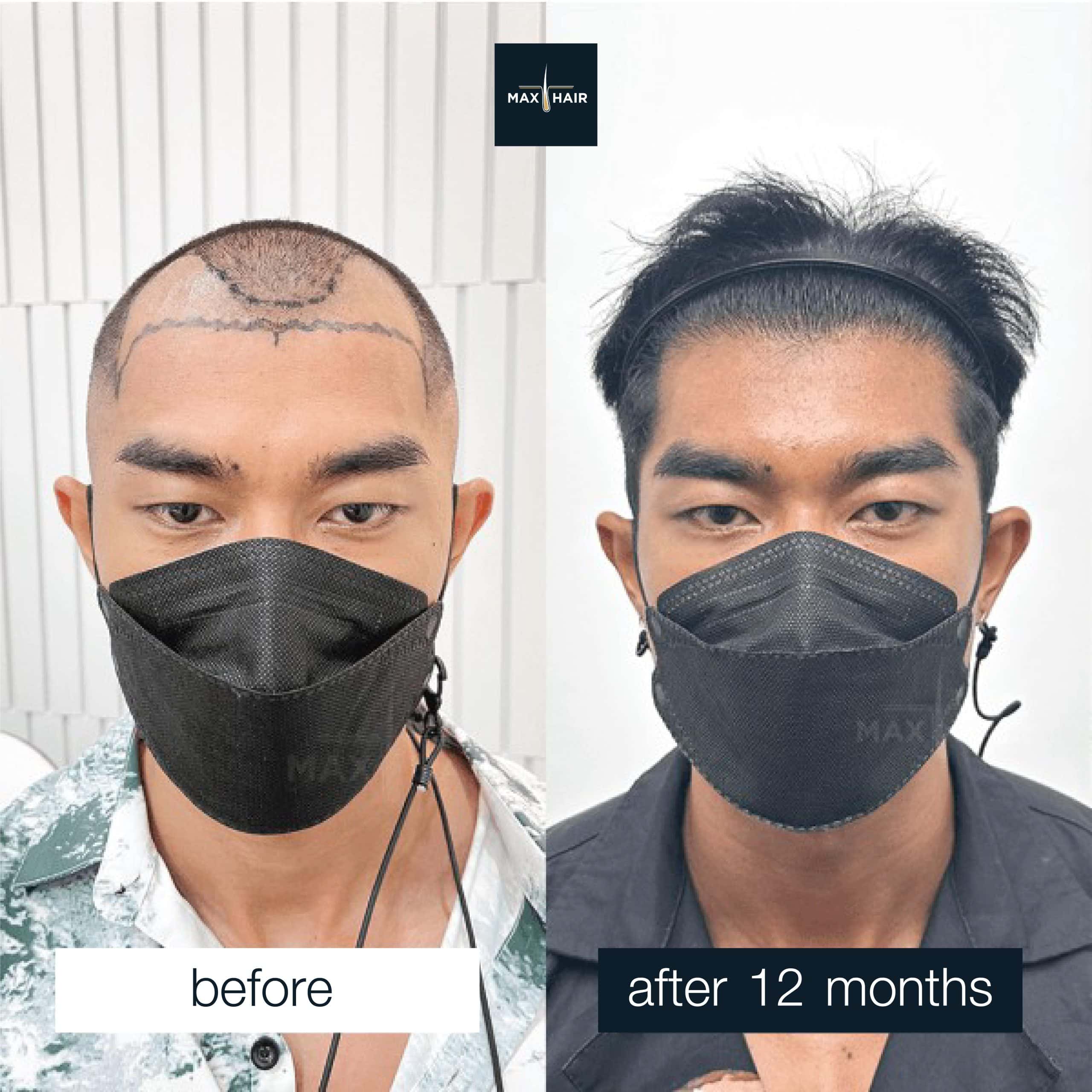Hair transplant progress photo showing gradual improvement