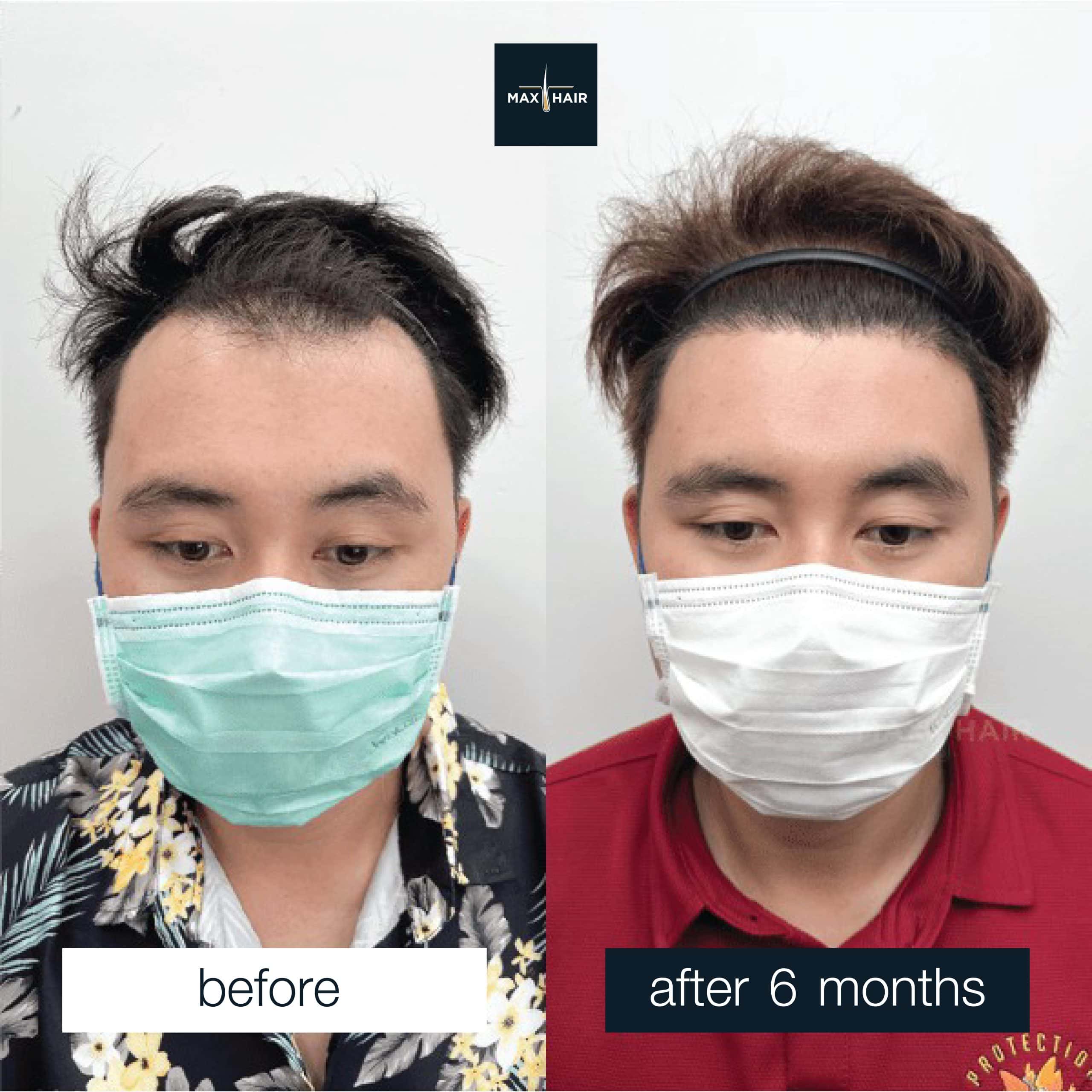 Hair transplant before and after 6 months in man with receding hairline.