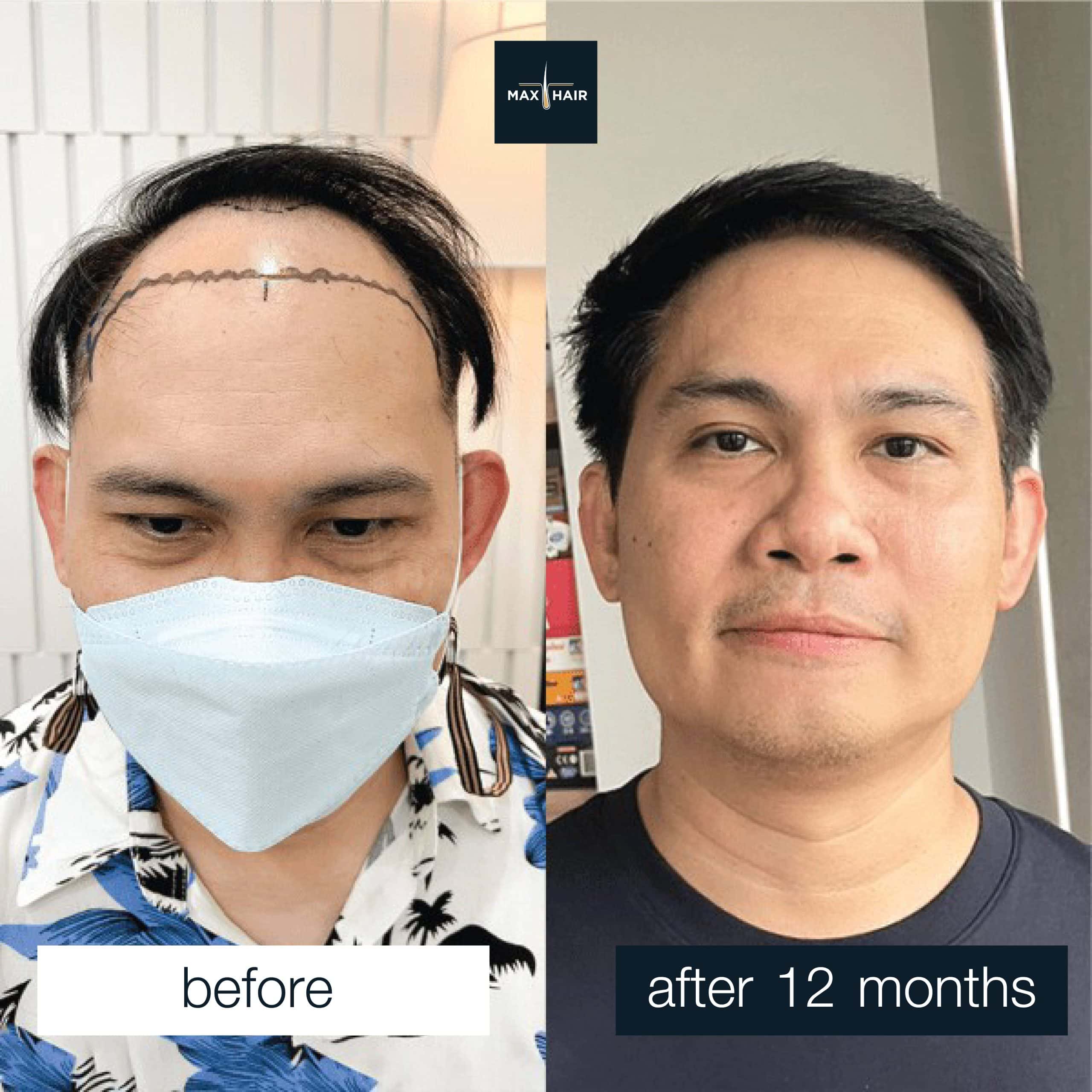 Men's hair transplant review: MCG technique, 3,300 grafts