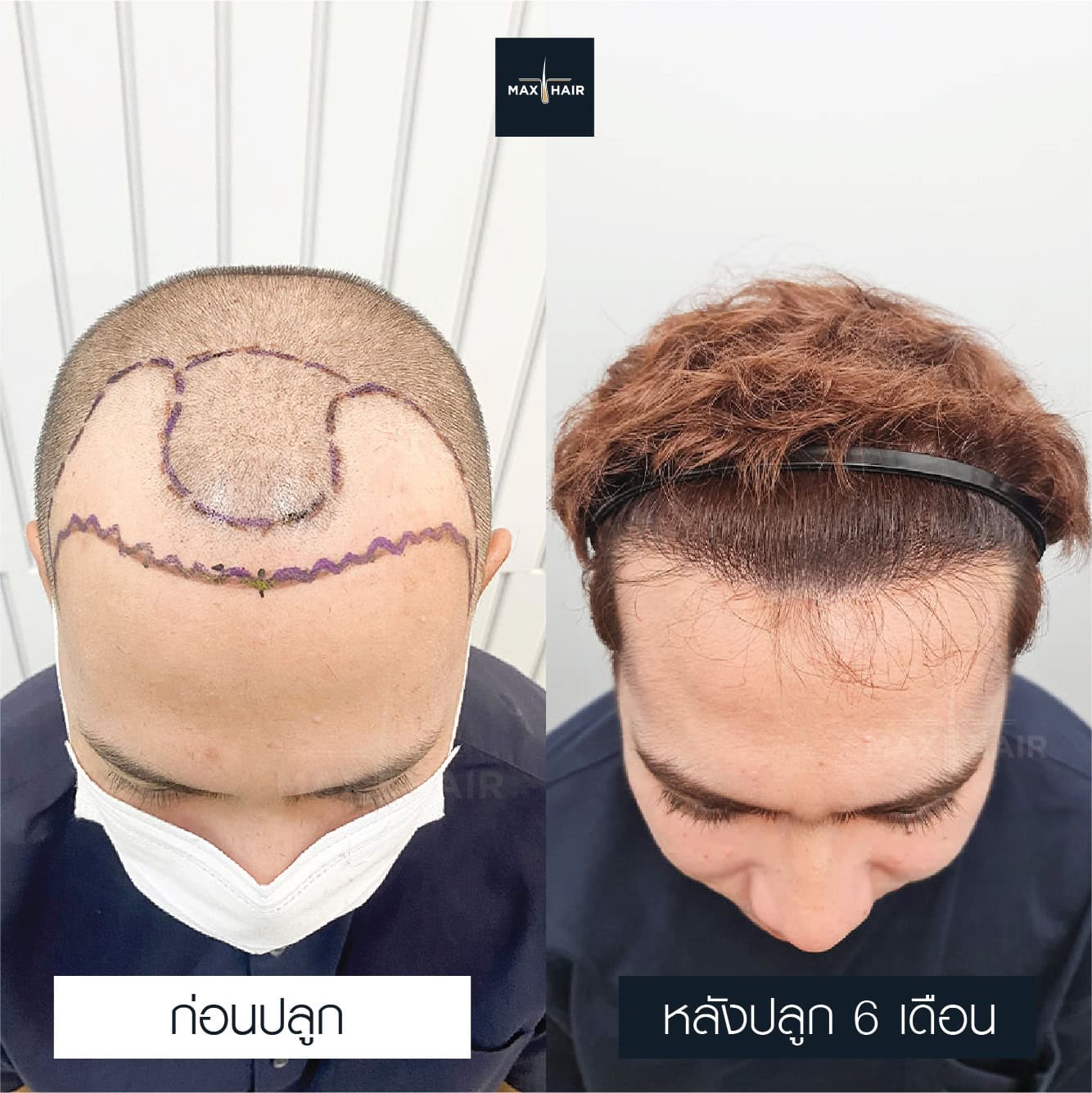Side by side comparison of a man's head before and after hair transplantation