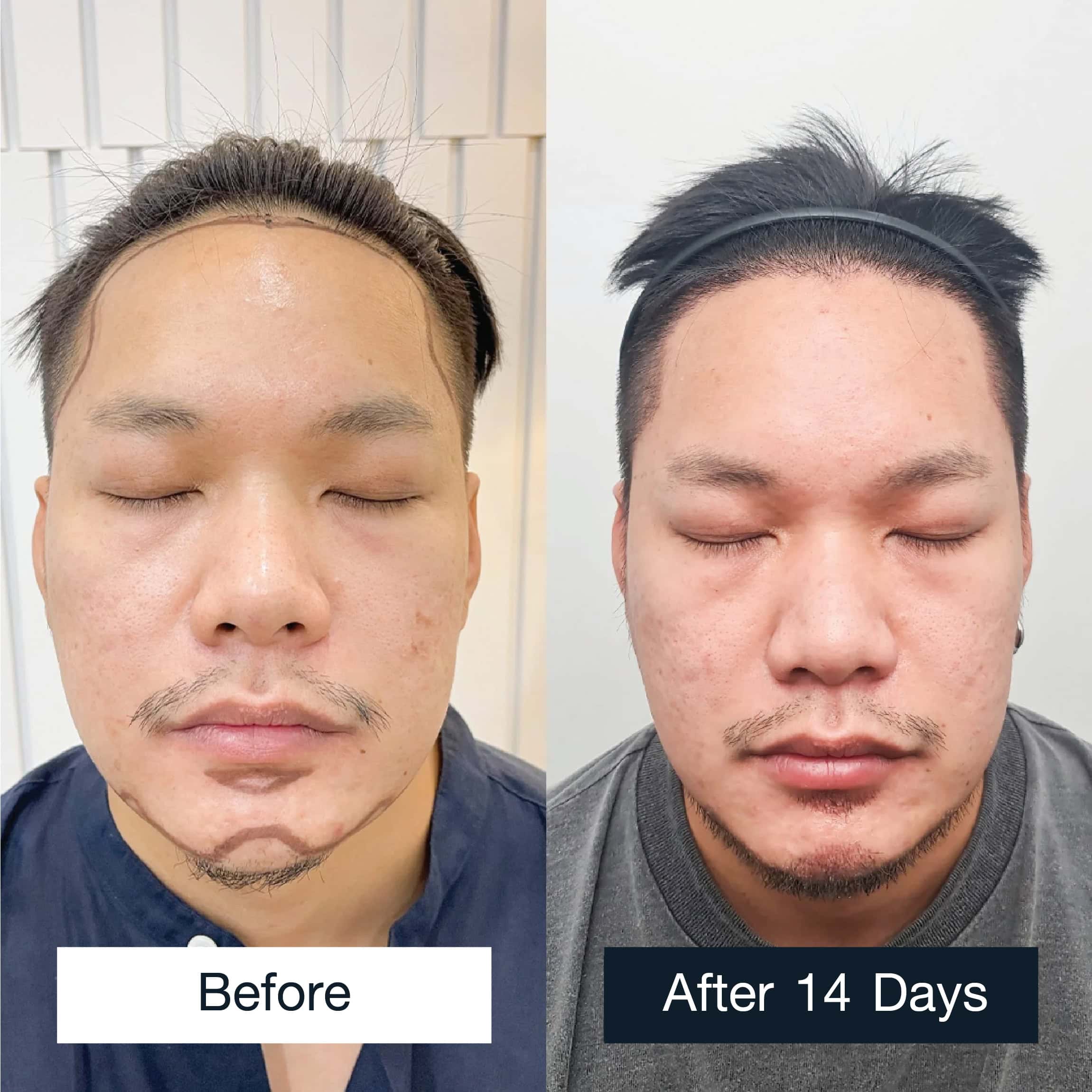 the results after a 14-day beard transplant