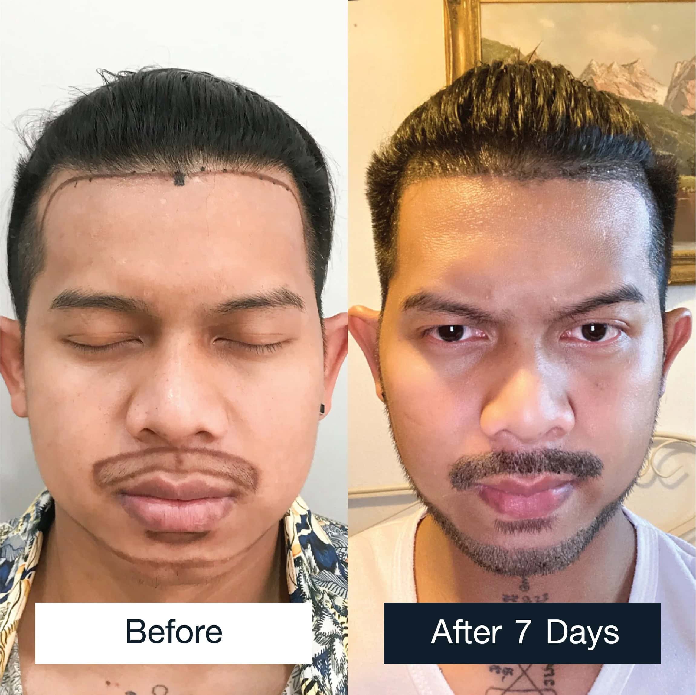 7-day review of beard and mustache transplant results
